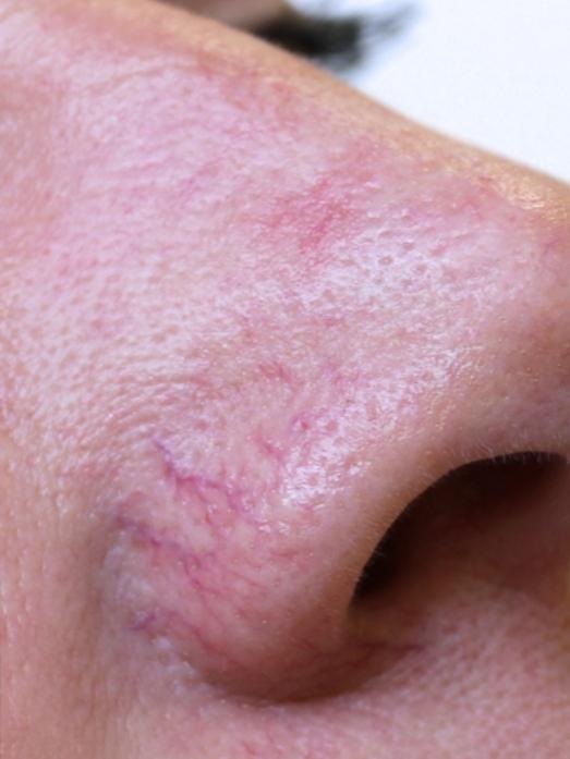 I have these kind of little veins on my nose. Does anyone have any tips