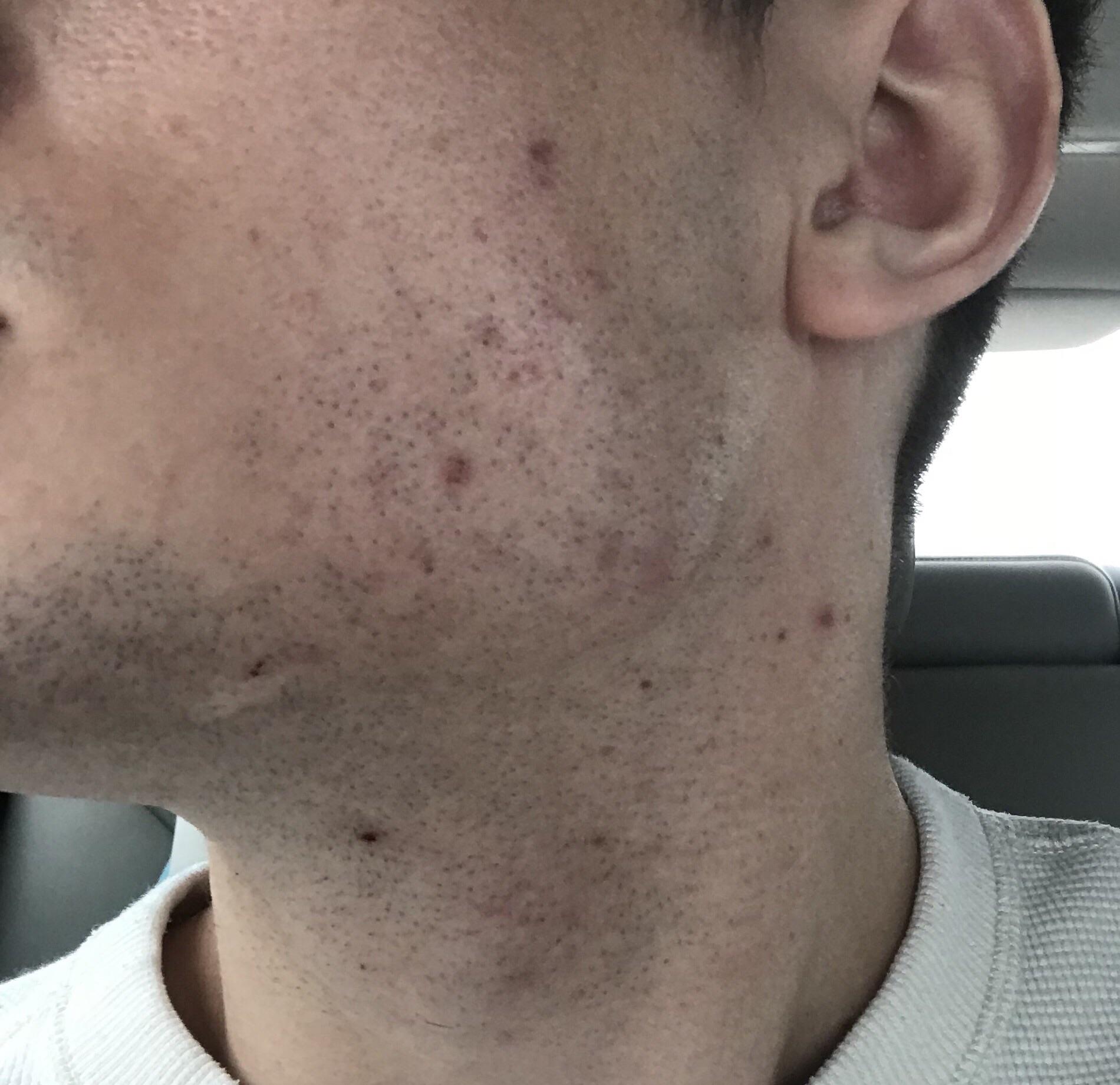 [Acne] Help with persistent cheek acne? r/SkincareAddiction