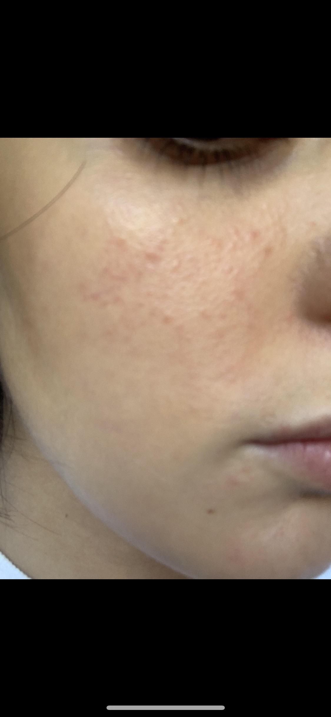 Has anyone tried 15 Azelaic Acid from FaceTheory? How did it go? Rosacea