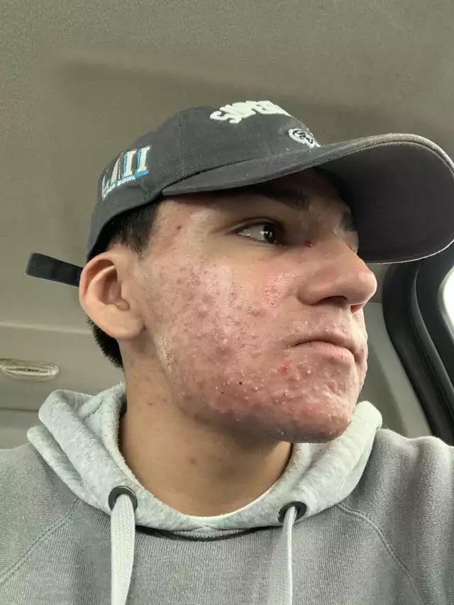 Cold sore? Accutane