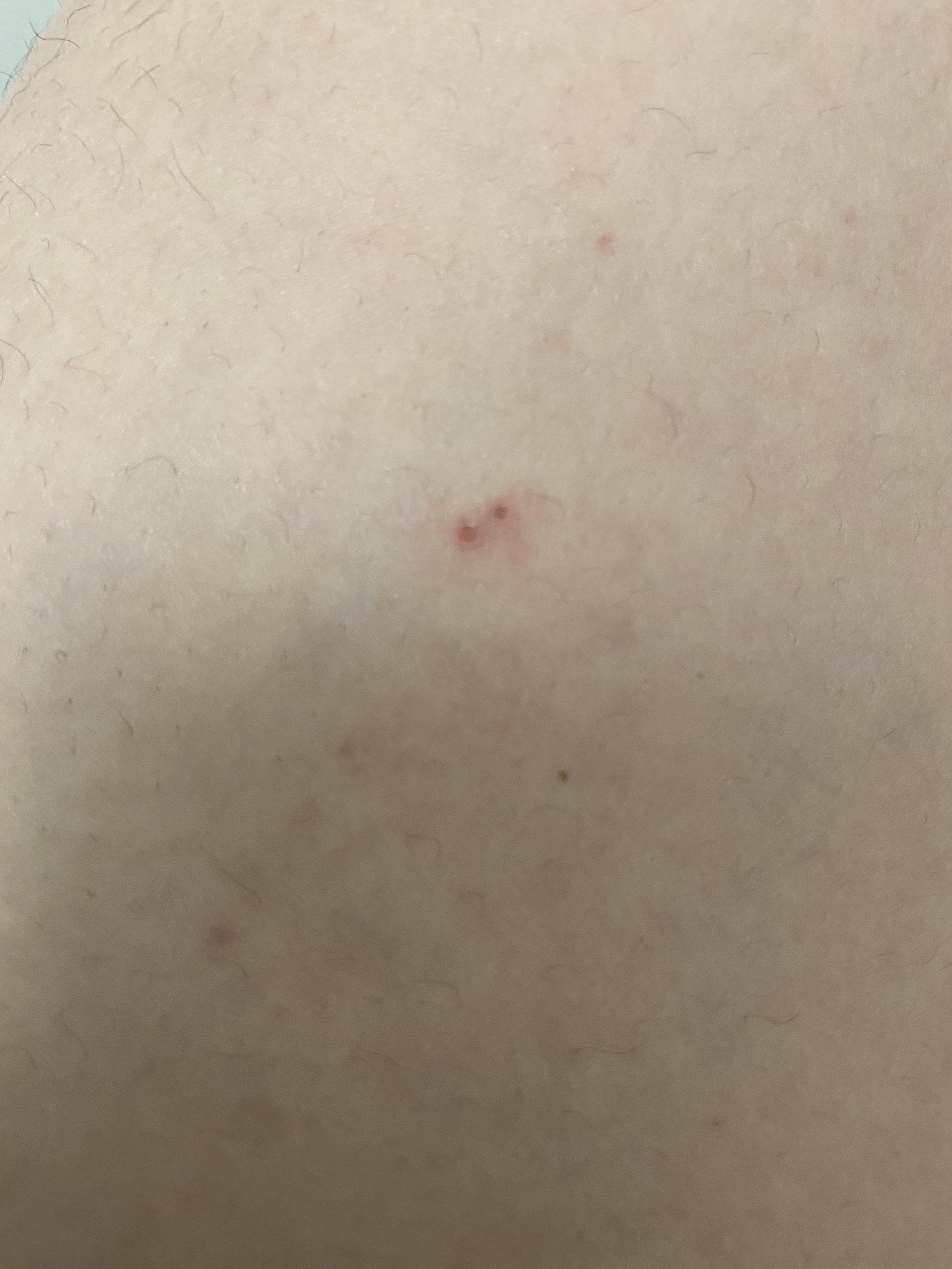 Should i be concerned? Is this a bug bite? medicalschool