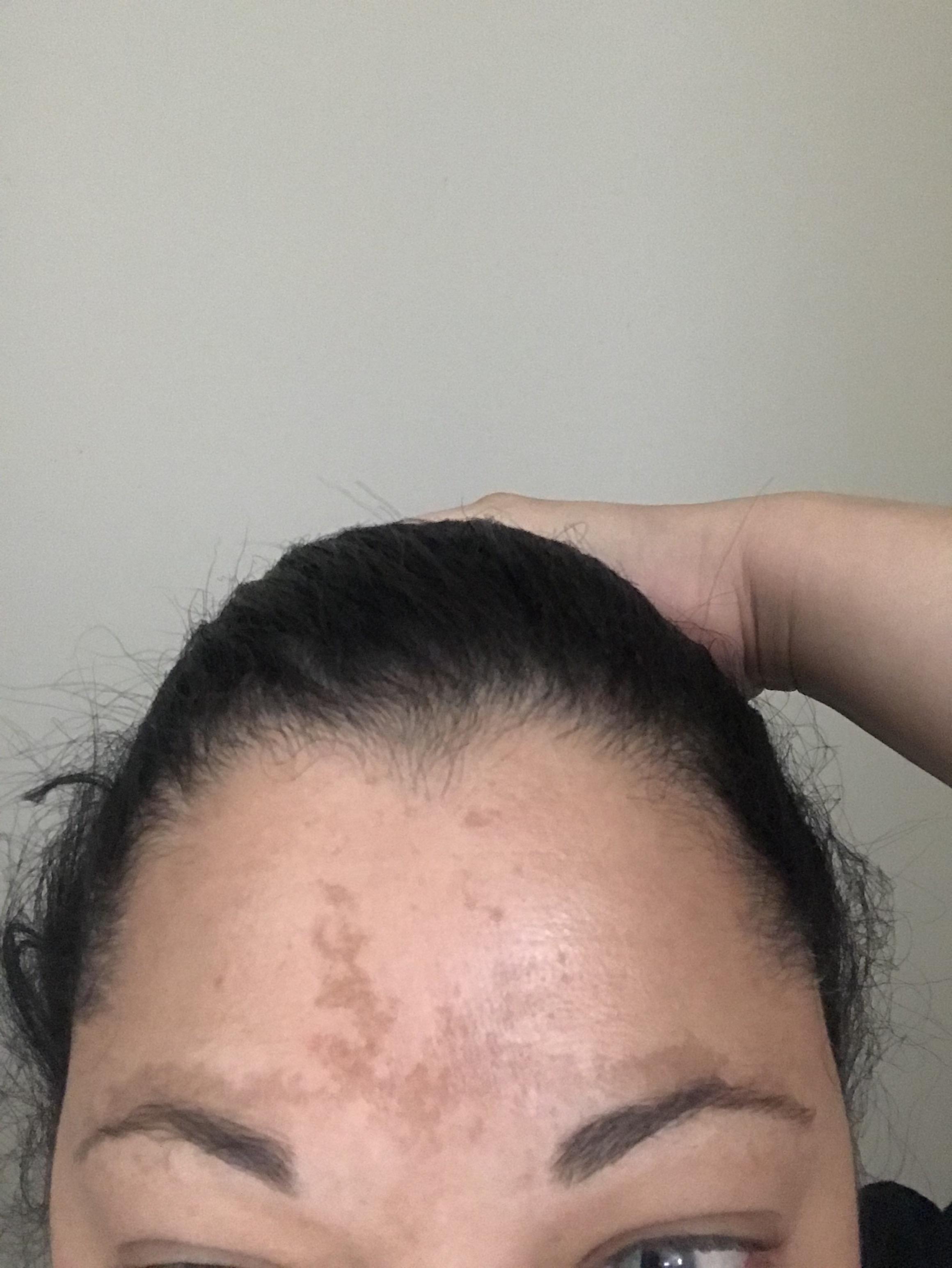 [Routine Help] Brand new to sub. I have melasma, has anyone had success with making it disappear