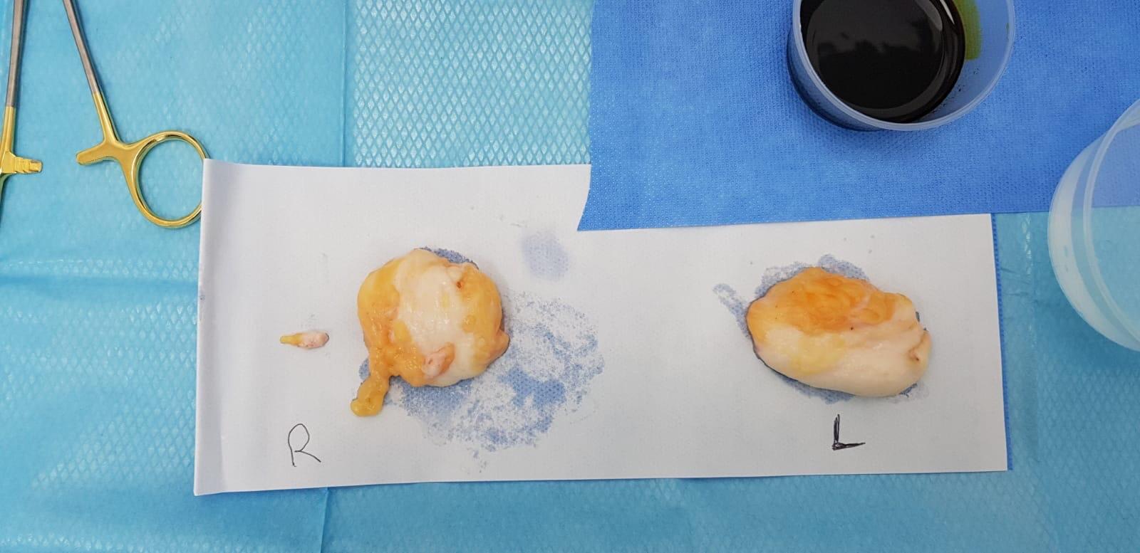 Glands taken from our first patient this morning. Surgery Time 112