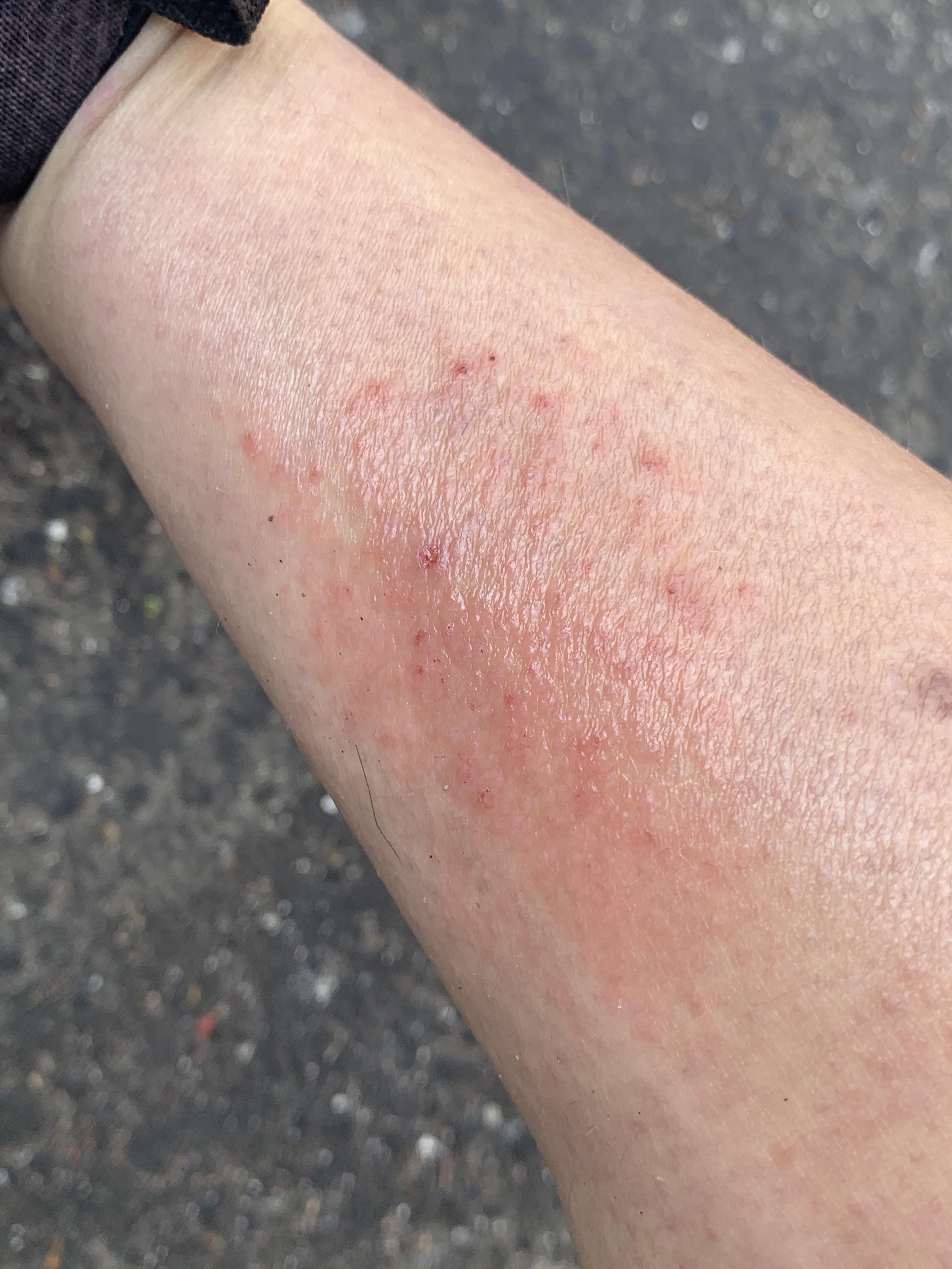 What is this rash on my calf? (More in comments) r/Dermatology