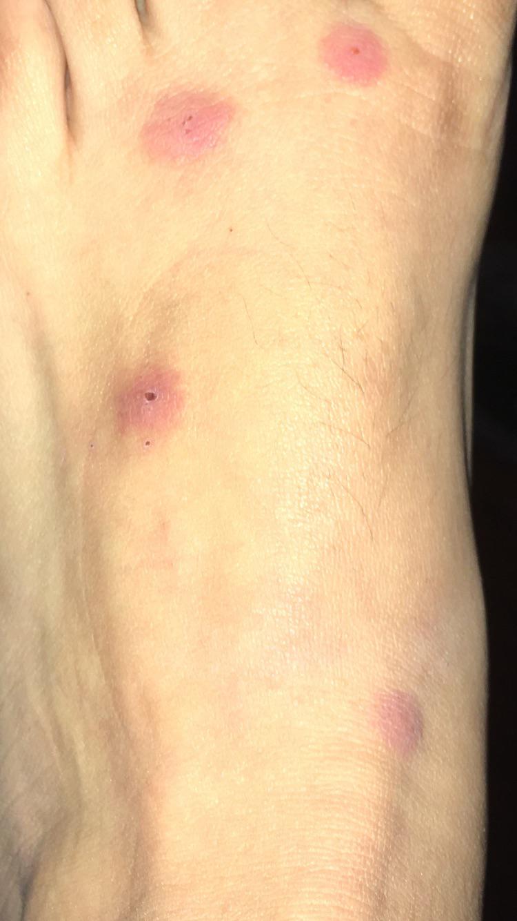 Are these bed bugs bites ,fleas or maybe a spider bite? Ihave tried to