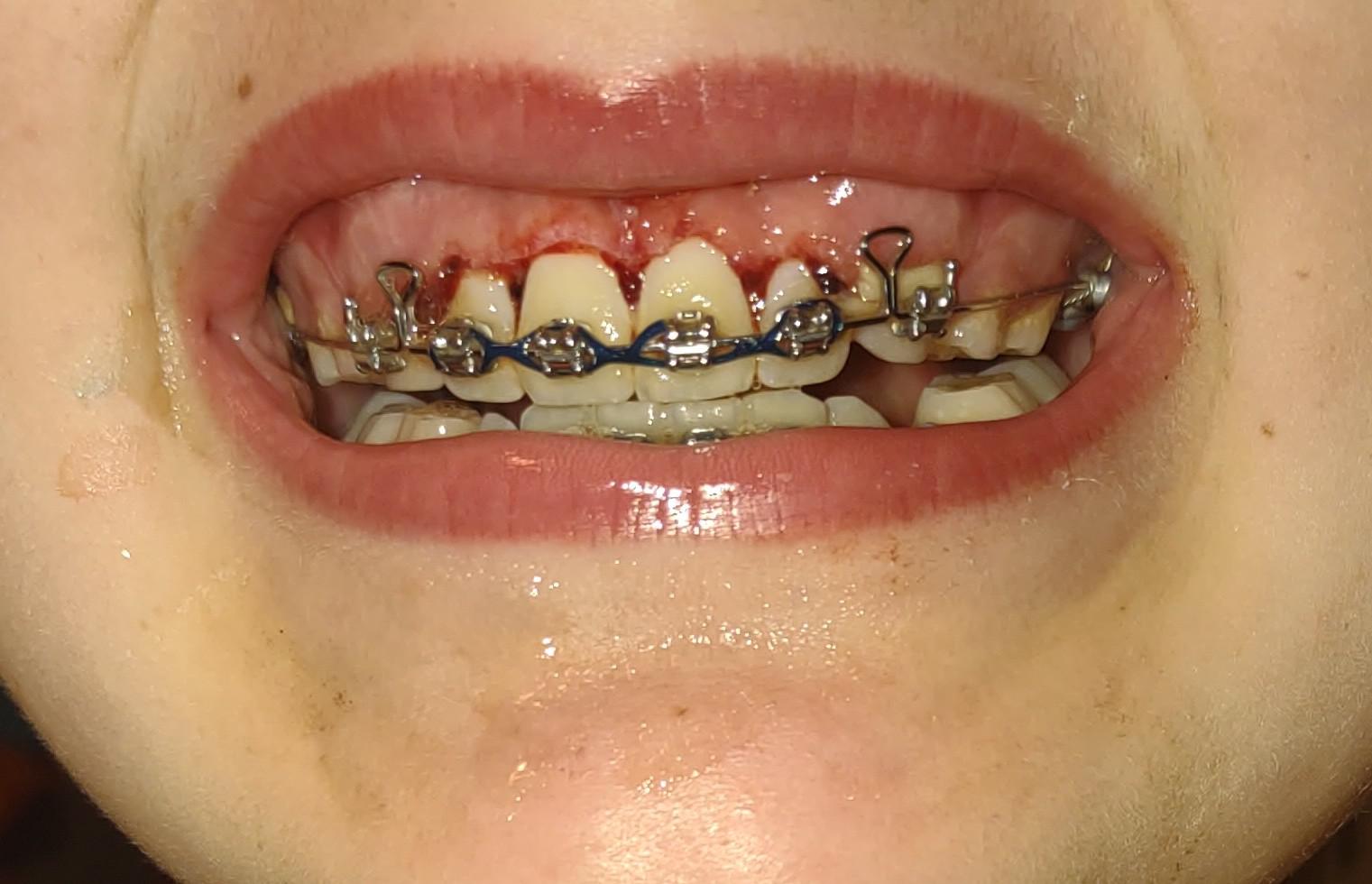 Was my son's gingivectomy over done on his front tooth?? It looks too