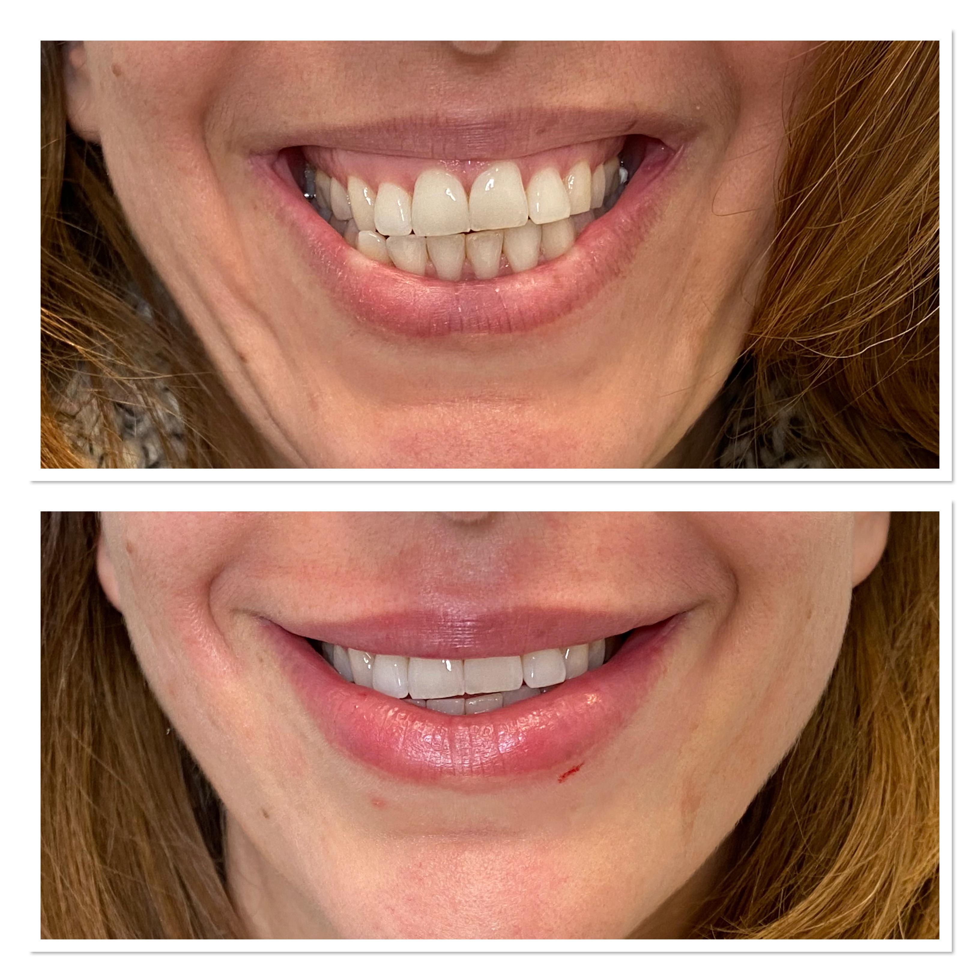 A Little Lip Filler and Gummy Smile Botox r/PlasticSurgery