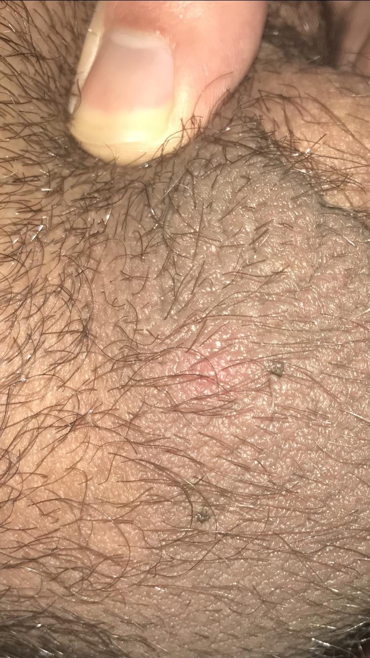 Weird bump on scrotum, maybe ingrown hair?? Haven’t been sexually