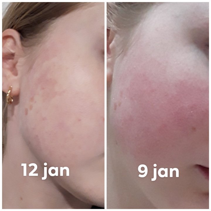 Skincare for my kprf and rosacea preparate( 0.3salicylic acid, 20urea, vitamin a,d, e, and