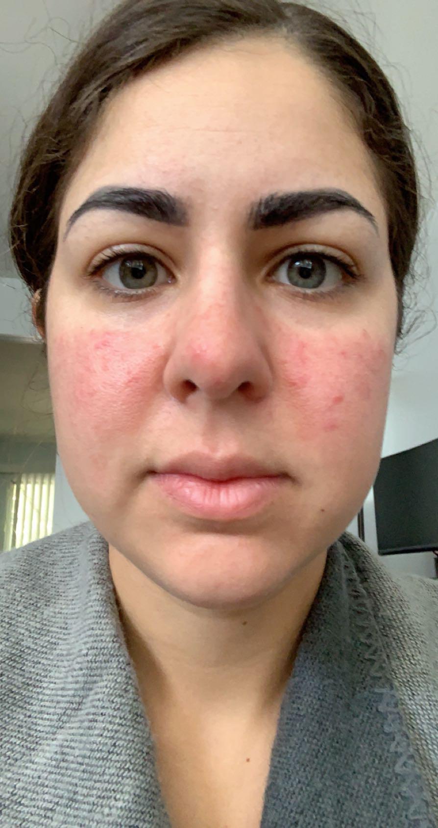 Hi does this look like the butterfly rash?? r/lupus