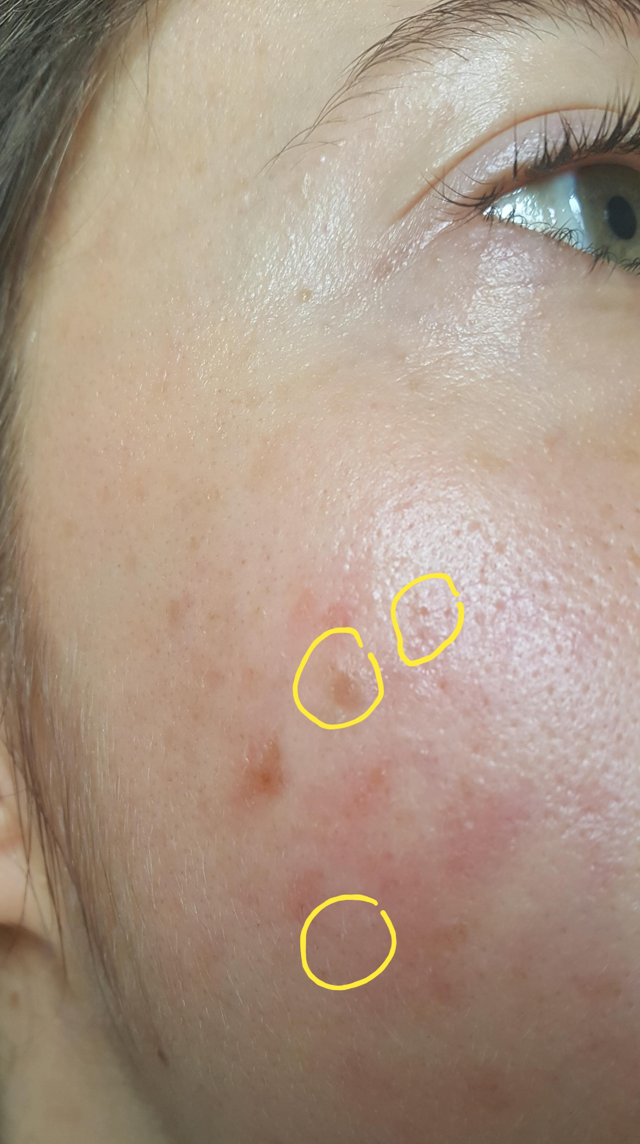 [Skin Concerns] BUMPS ,HARD PLUGS on my cheeks. What are they? KP