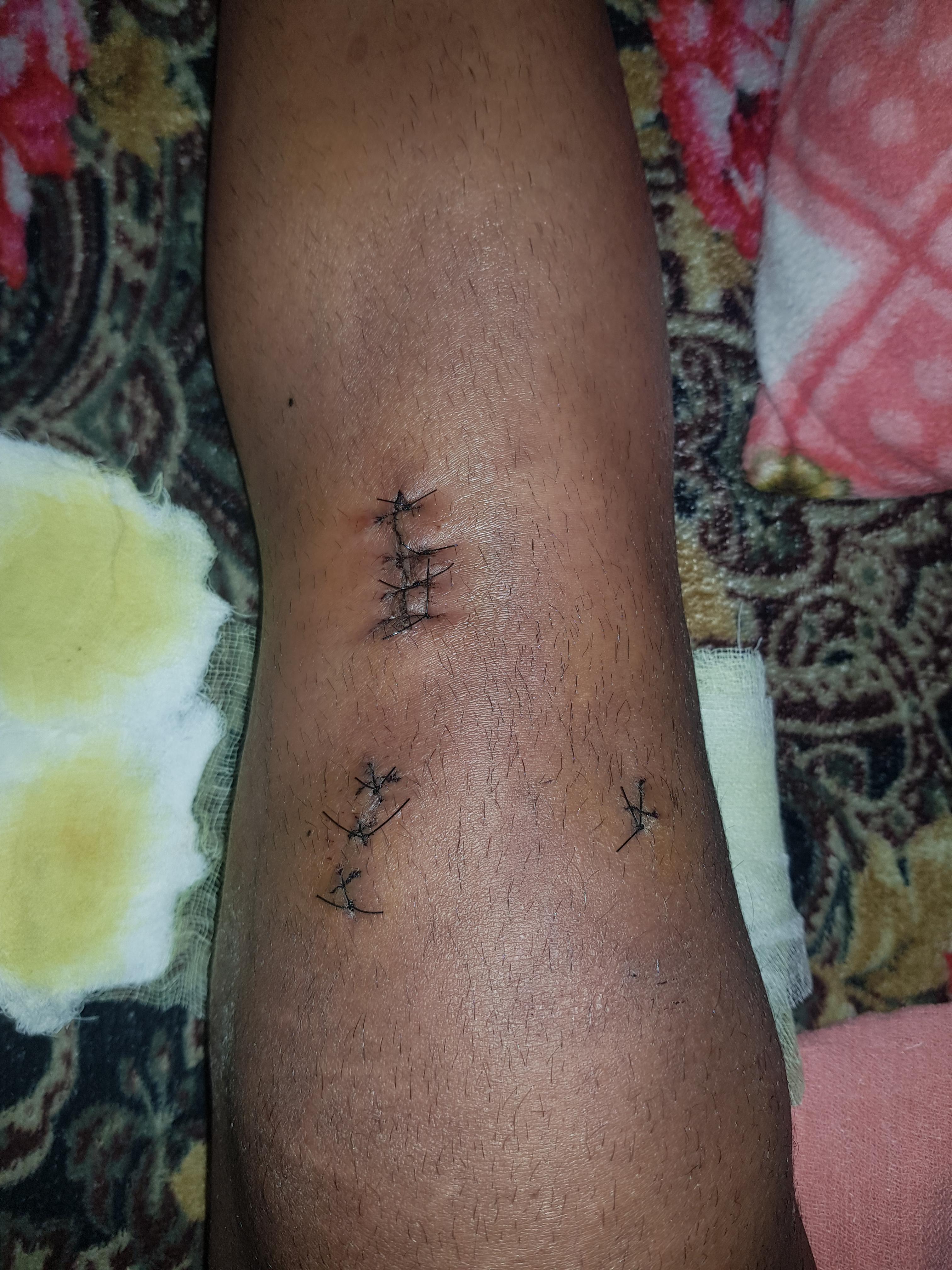 I got 8 (4+3+1) stitches on my right knee after ACLR? How much you all