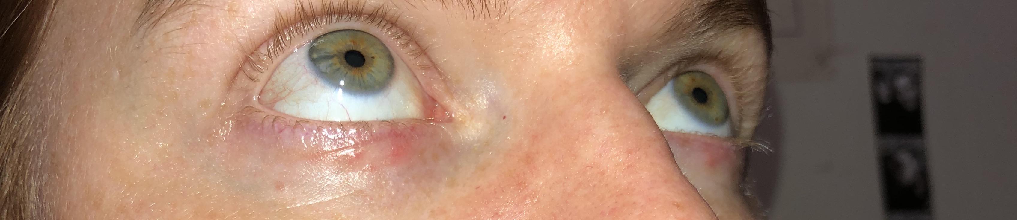 Under eye irritation from tret? tretinoin