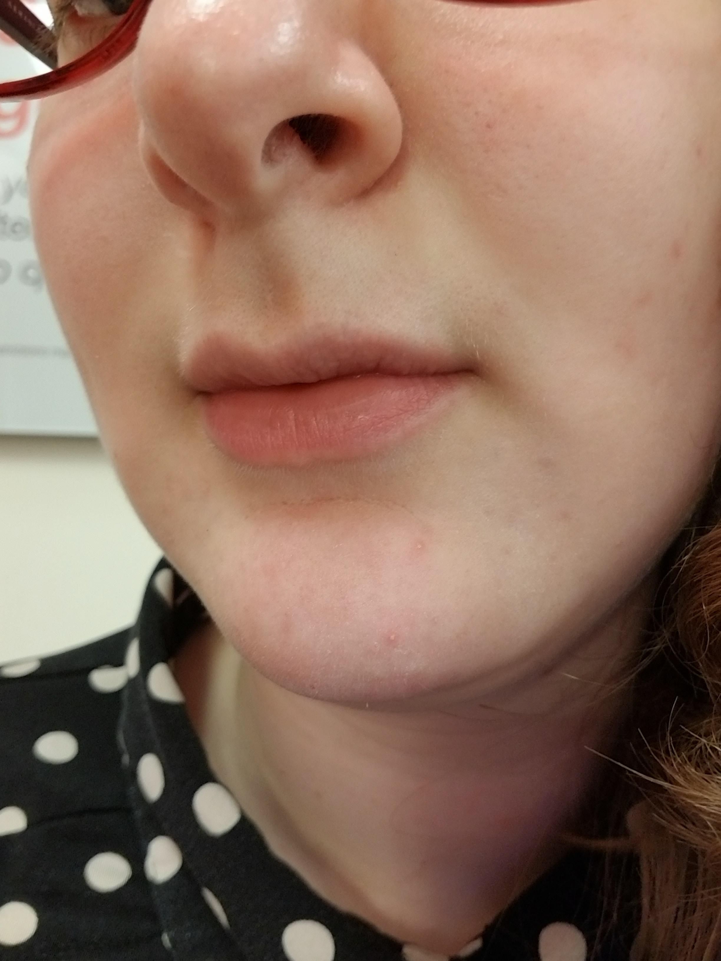 You see these zits on my chin? You'll see them again tomorrow. Thanks