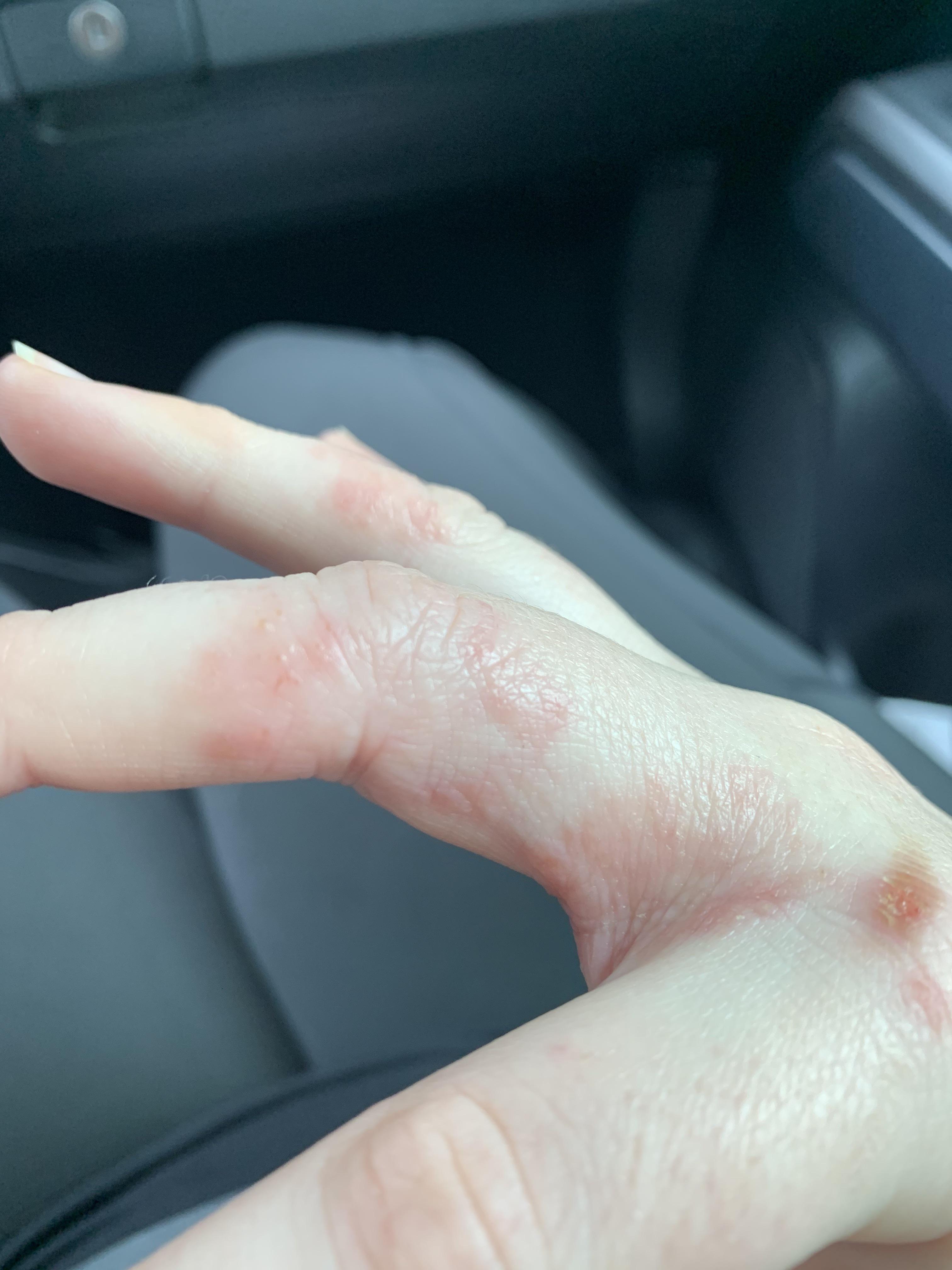 Help?!!! This started as just patches of dry skin on my knuckles and