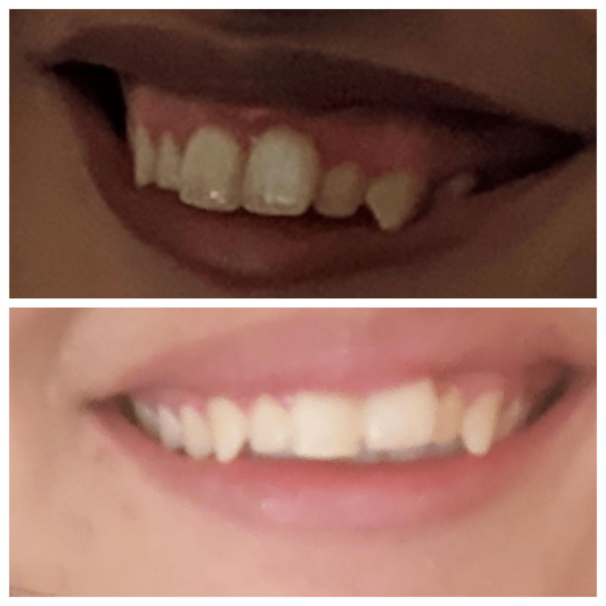 Before and After Jeuveau for Gummy Smile PlasticSurgery