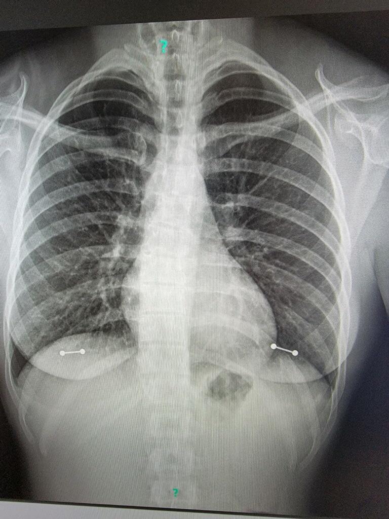 just wanted to share my chest x ray with y’all. r/piercing
