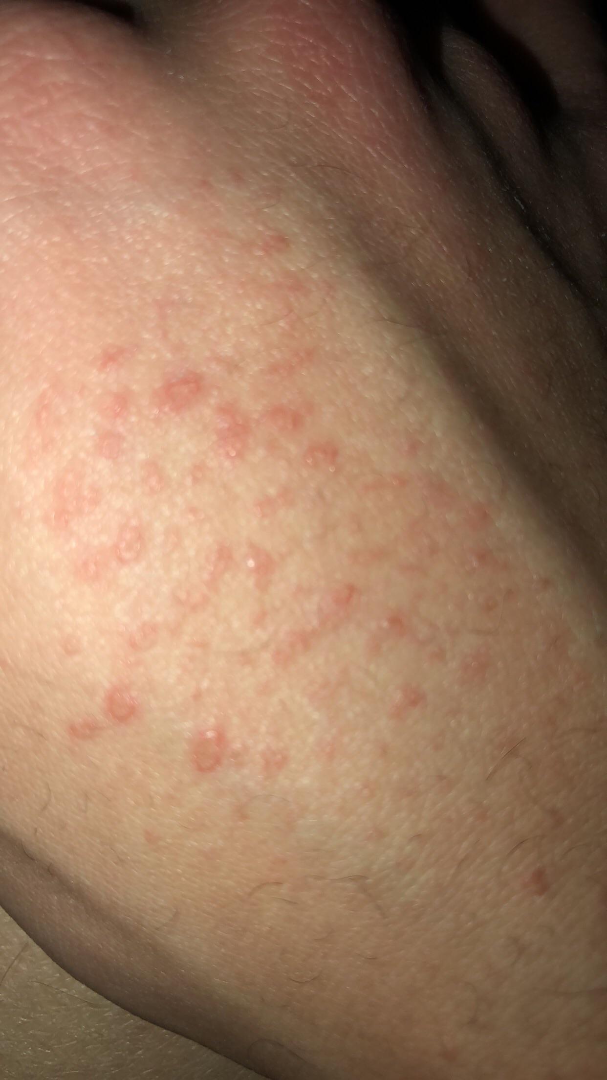 Accutane Rash Popular in Atopic Dermatitis / Eczema