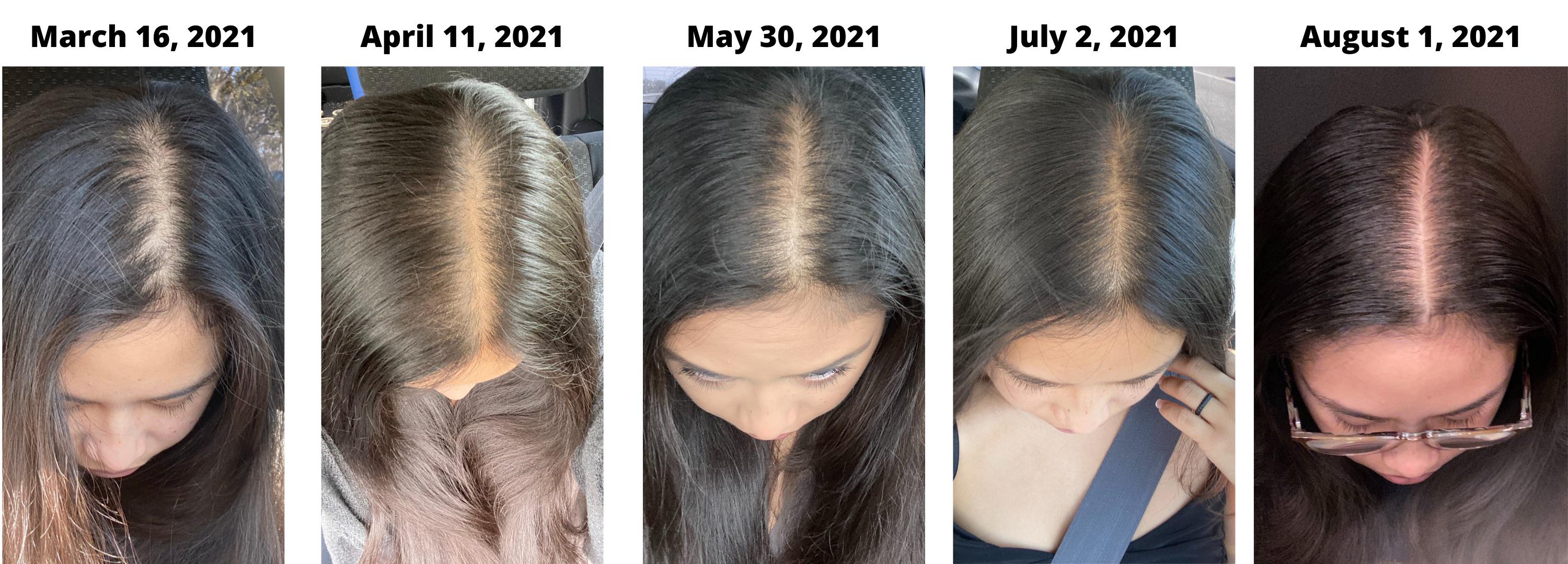 More Minoxidil Progress! I posted here a month ago but I decided to