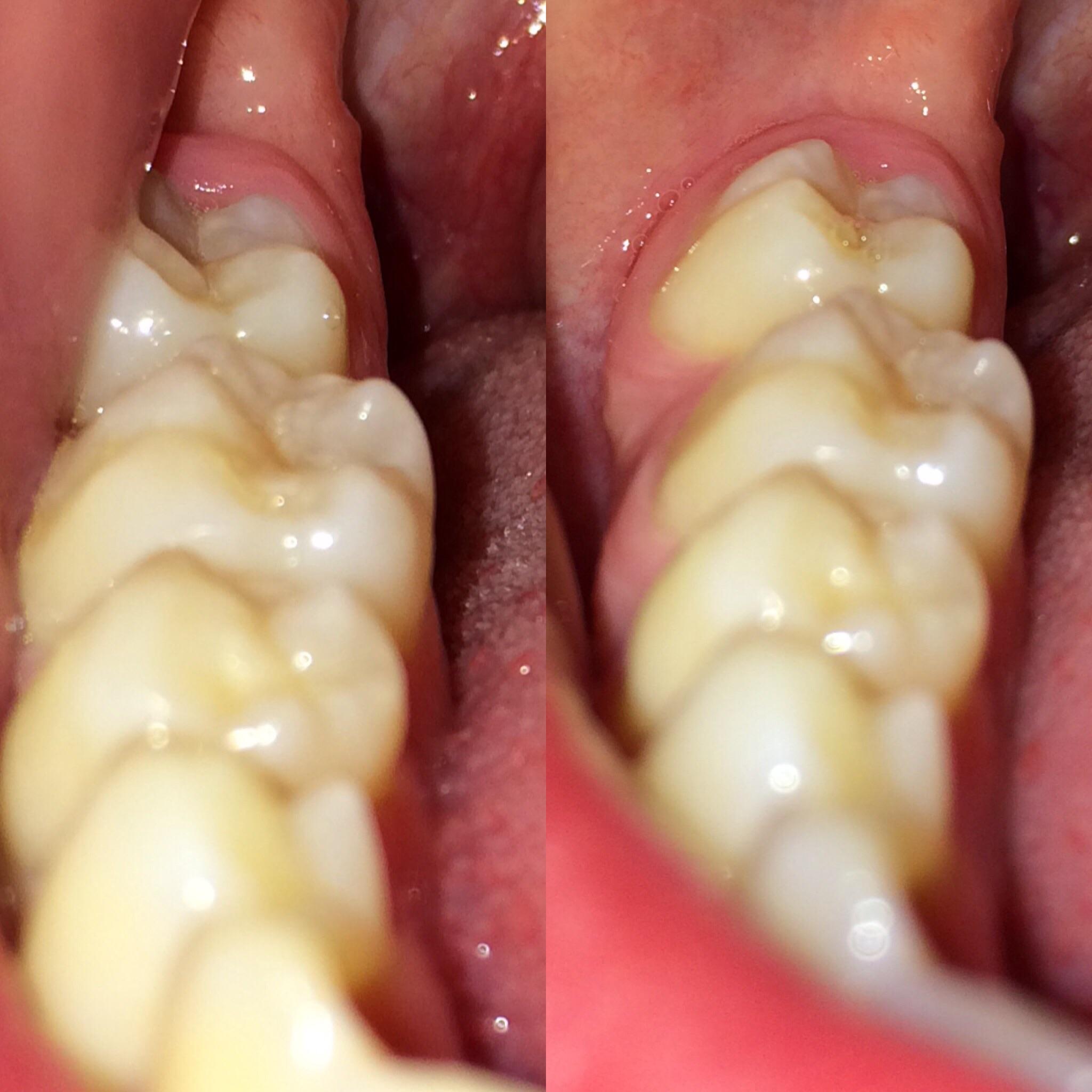 Kiddo just got braces off last week. Been wearing retainer religiously