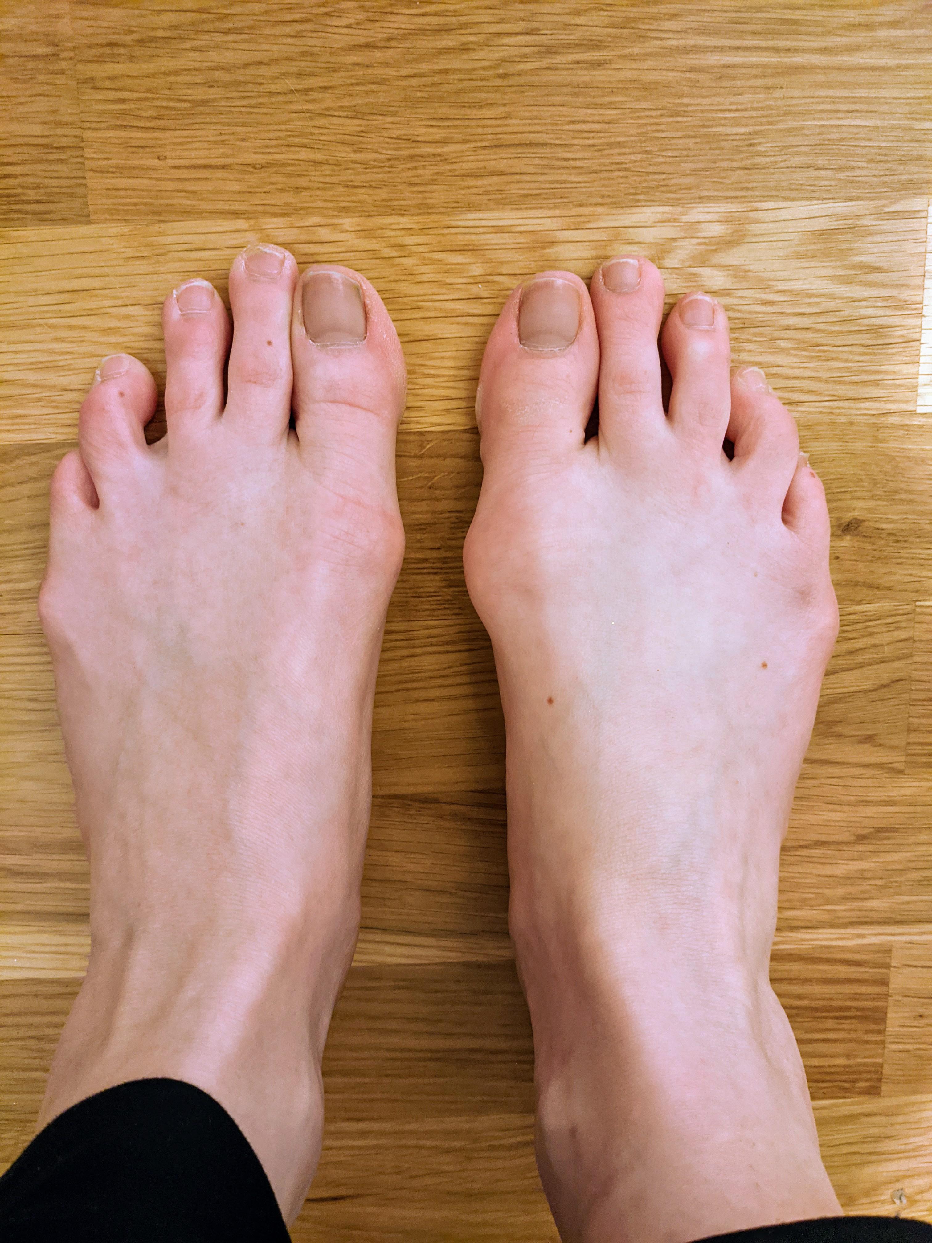 Bunion pain location... I think i have a bunion on my right foot. The