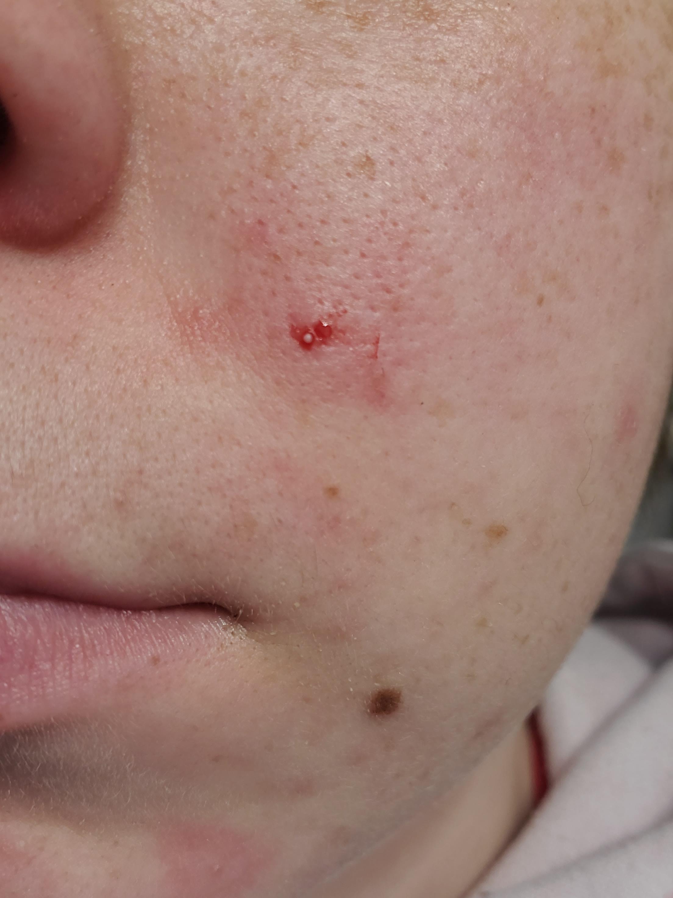 White ball hiding under my skin for a month r/popping