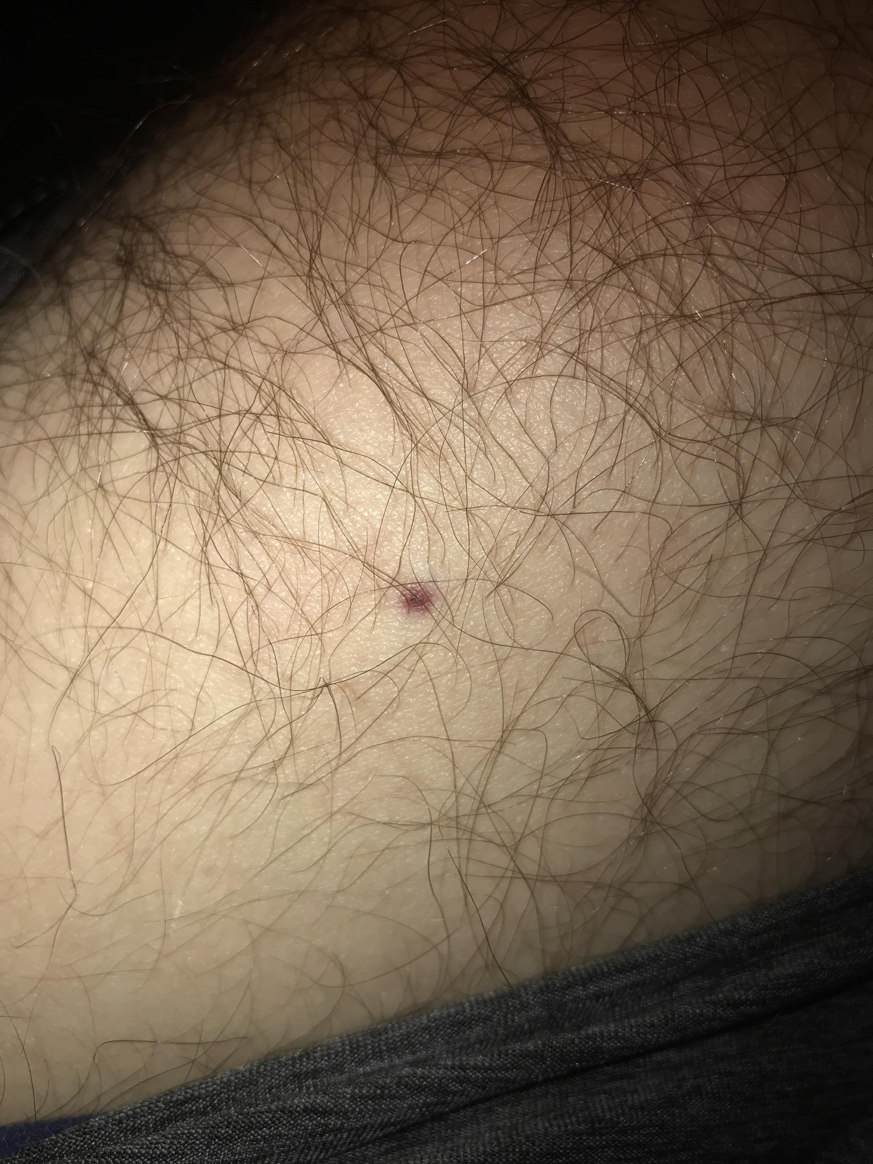 Common to see red spot at quad injection site? 2nd time at this and