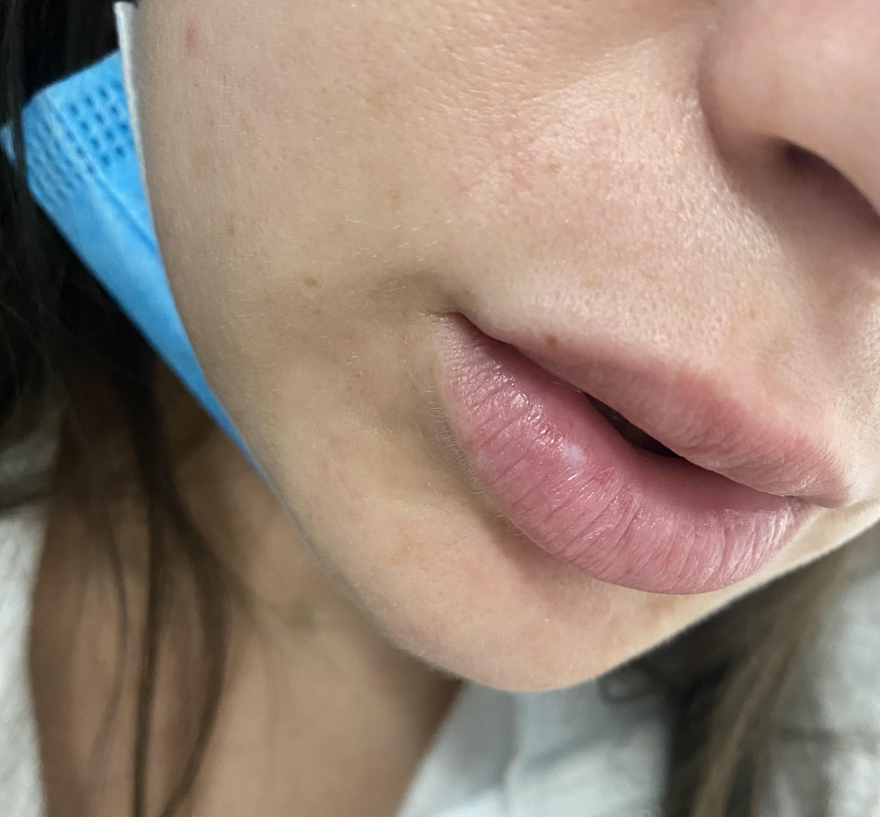 White spot on lip Help. Painless, not raised, has been here a few