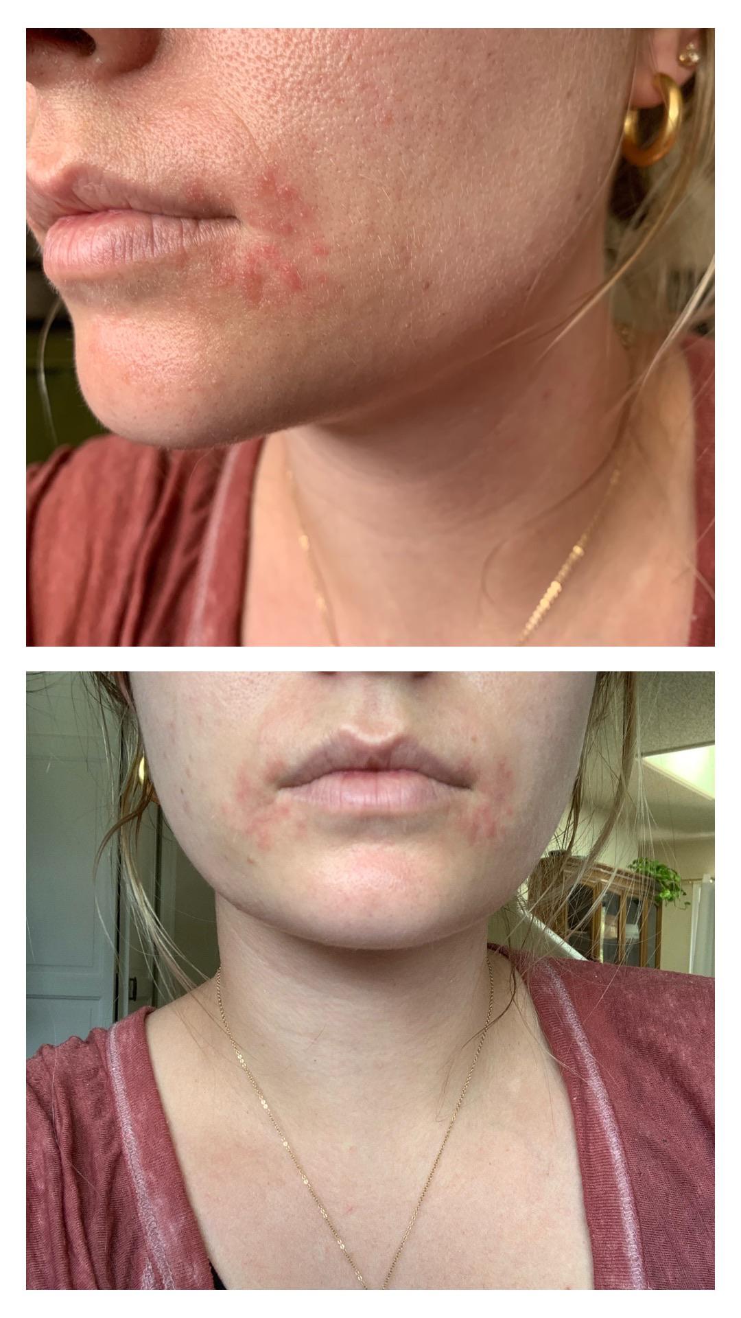 [Skin Concerns] Red/bumpy/flaky skin on either side of my mouth just