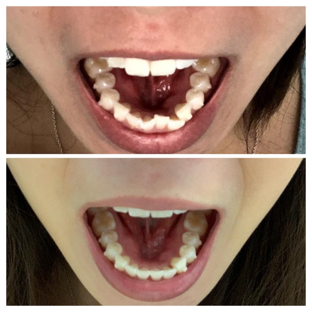 Tray 0 vs. (end of) tray 13 of 16! Invisalign