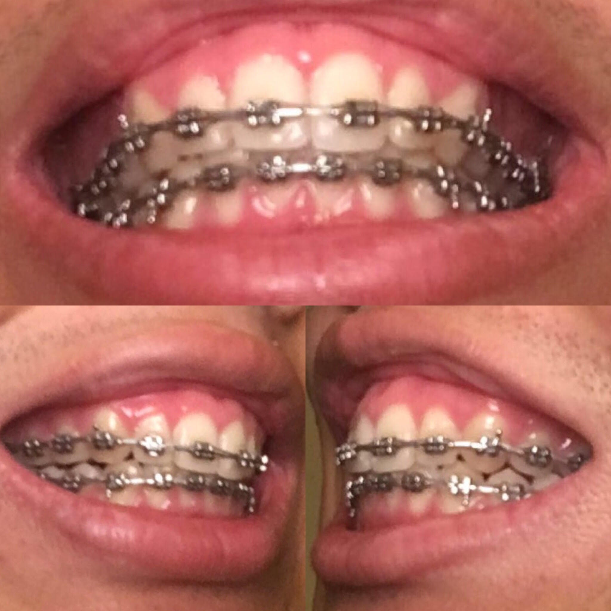 How To Take Braces Off Teeth TeethWalls