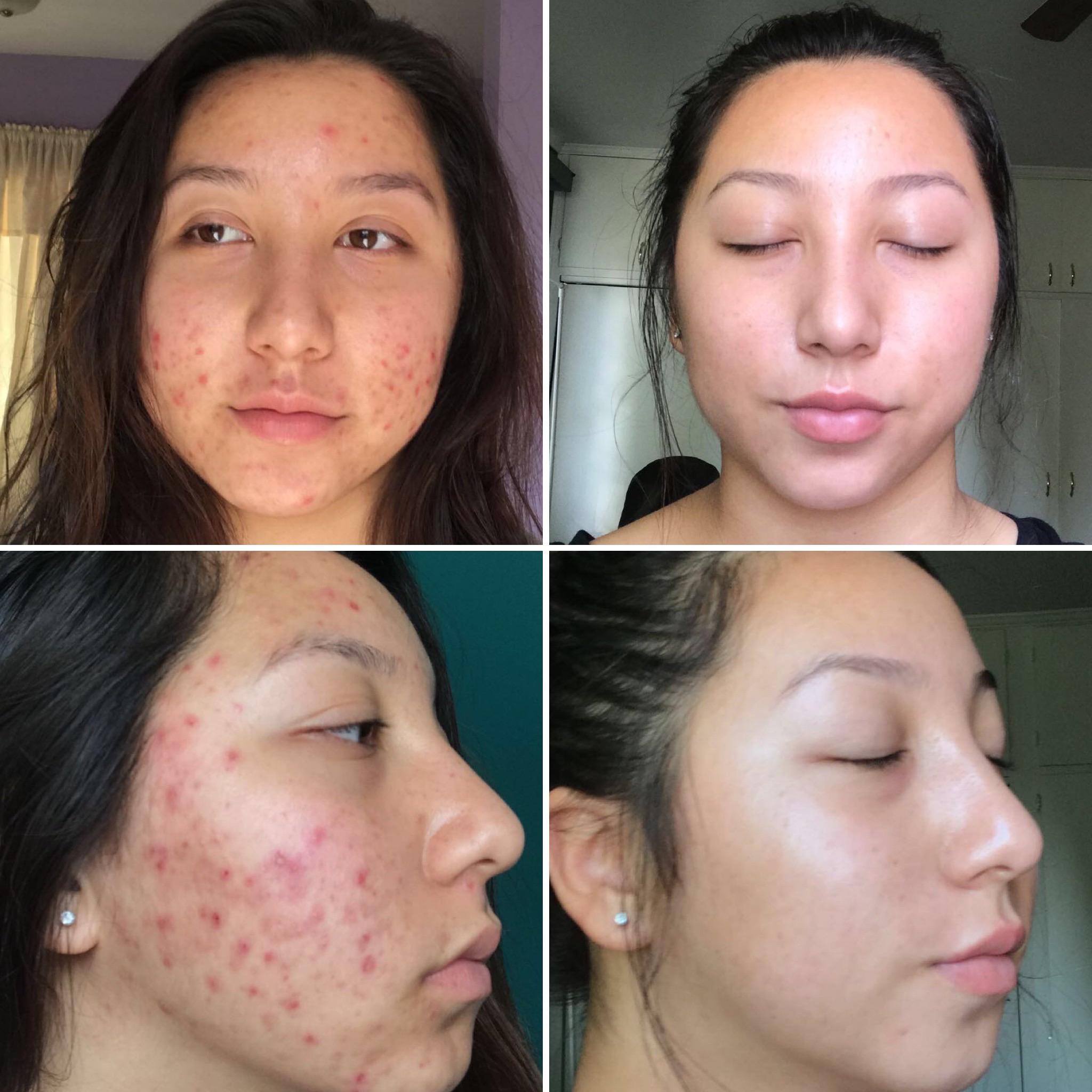 6 months isotretinoin (Accutane) then 6 months of Tretinoin .025 gel