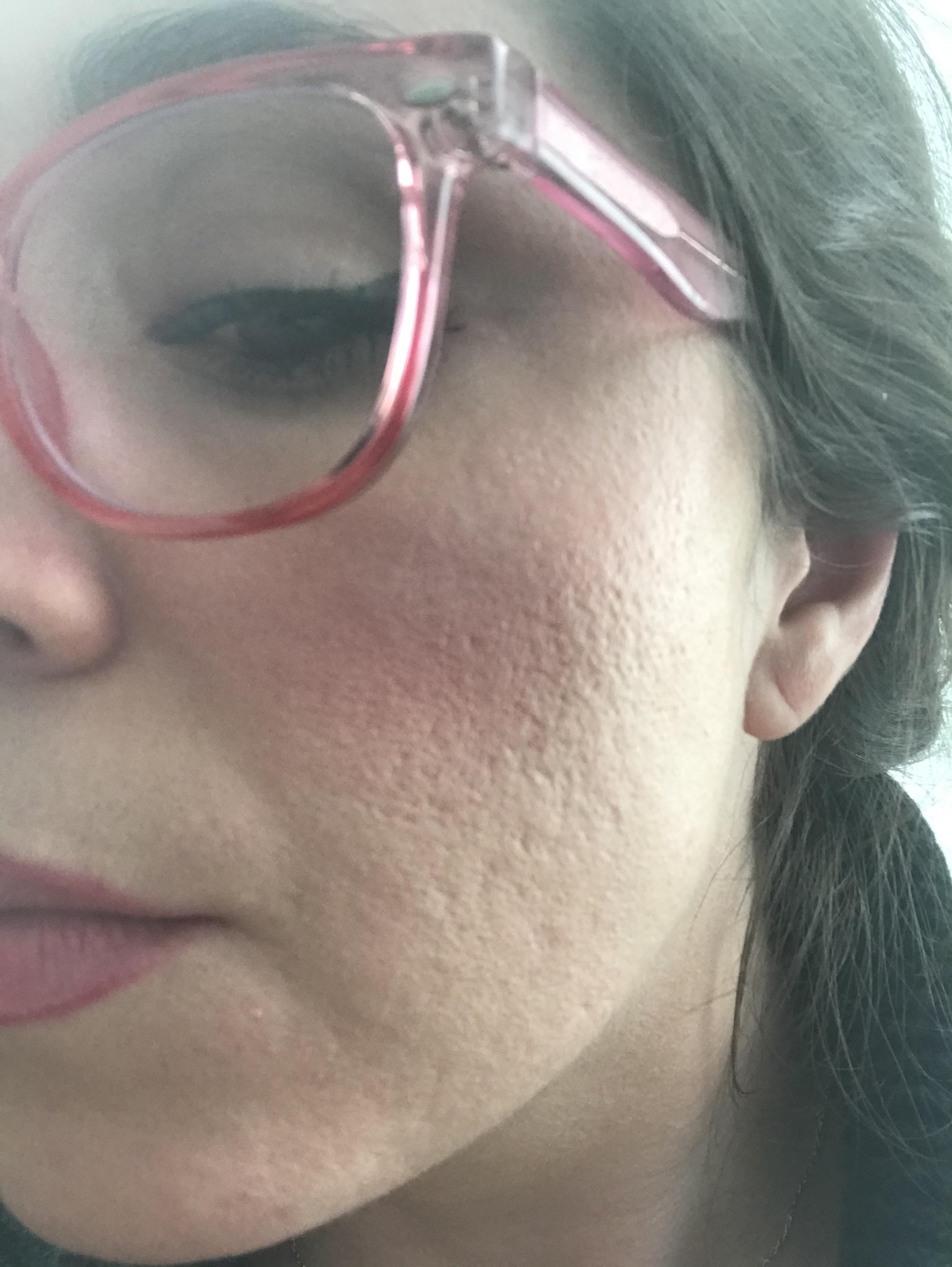 Can microdermabrasion help my acne scars? r/30PlusSkinCare