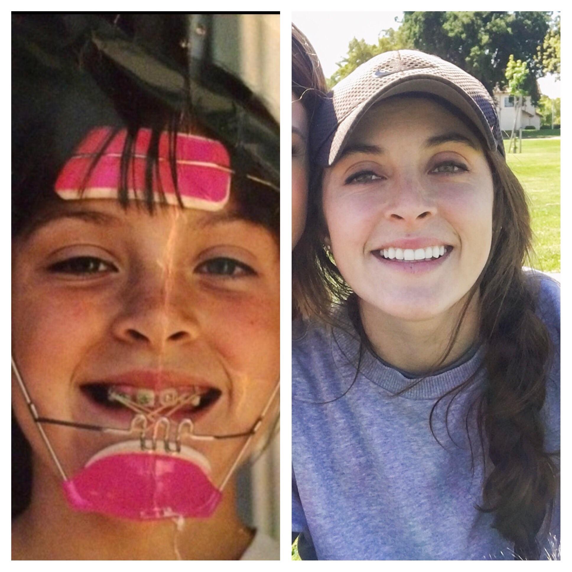 Headgear Braces Willy Wonka