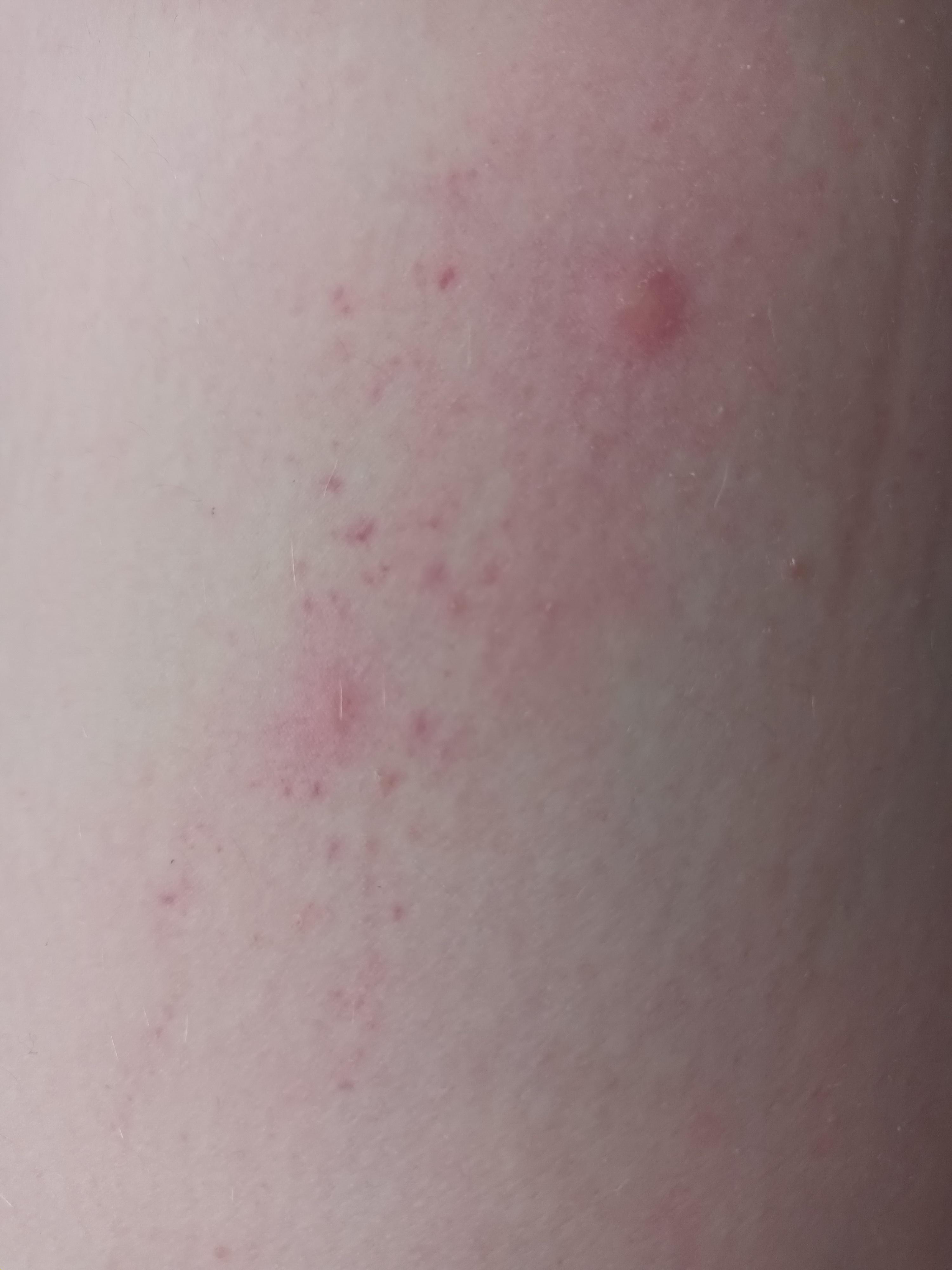 Purple dots around mosquito (?) bites. r/DiagnoseMe