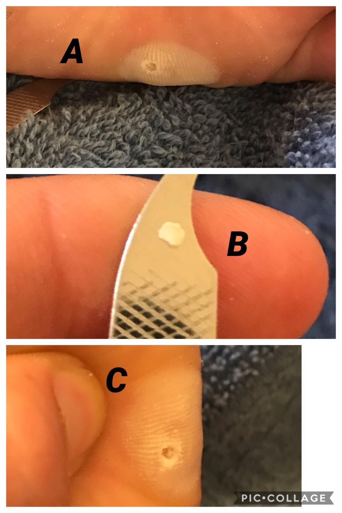 Weird callus or wart? A)After two callus remover treatments. B)The