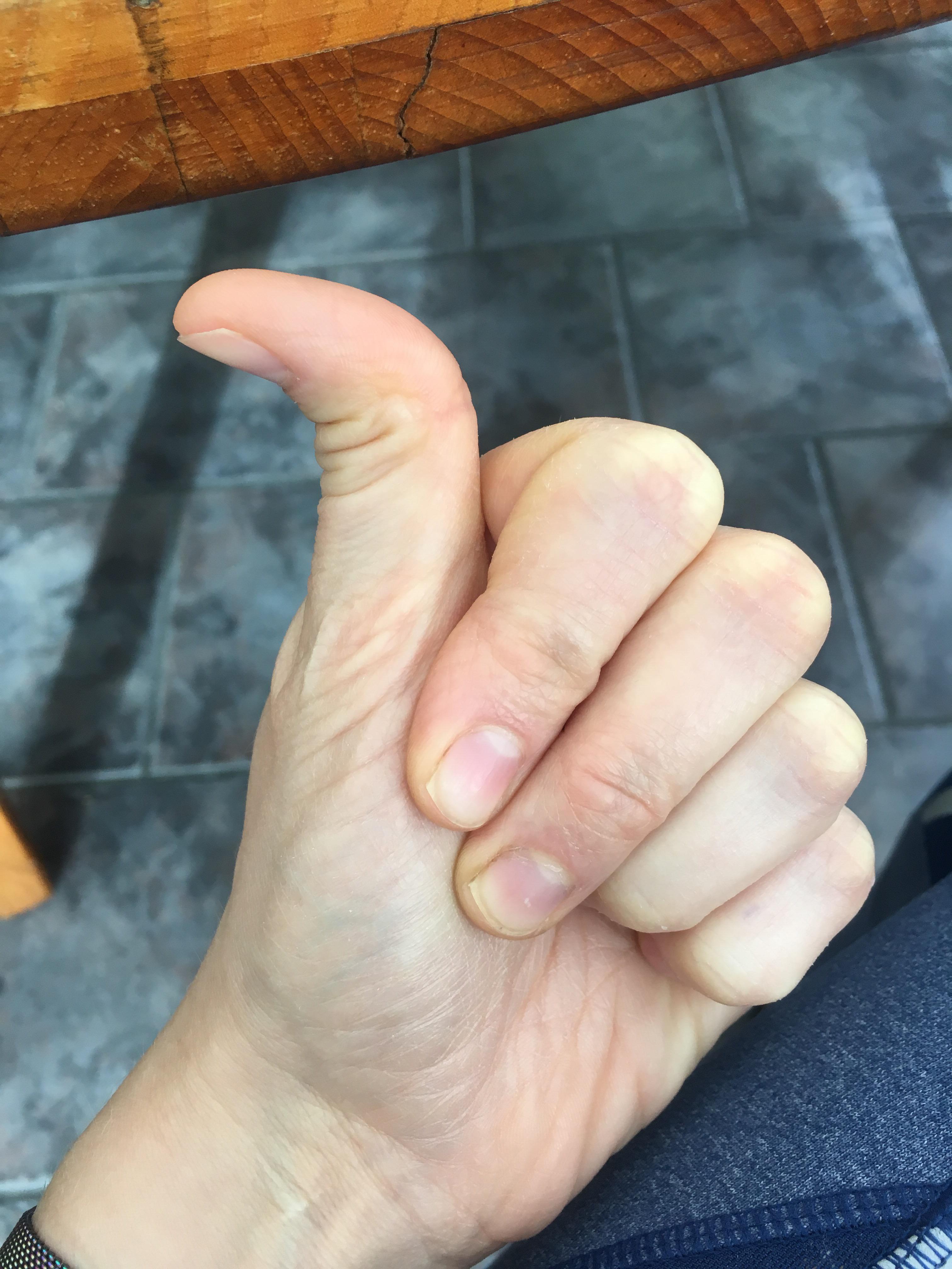 My hitchhikers thumb. I posted to a different subreddit yesterday to identify a plant, and this