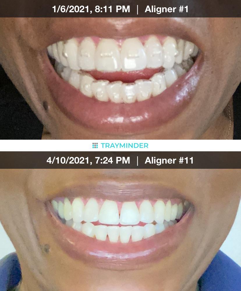 My journey is complete 😁11 trays and no refinements!! Dentist gave me