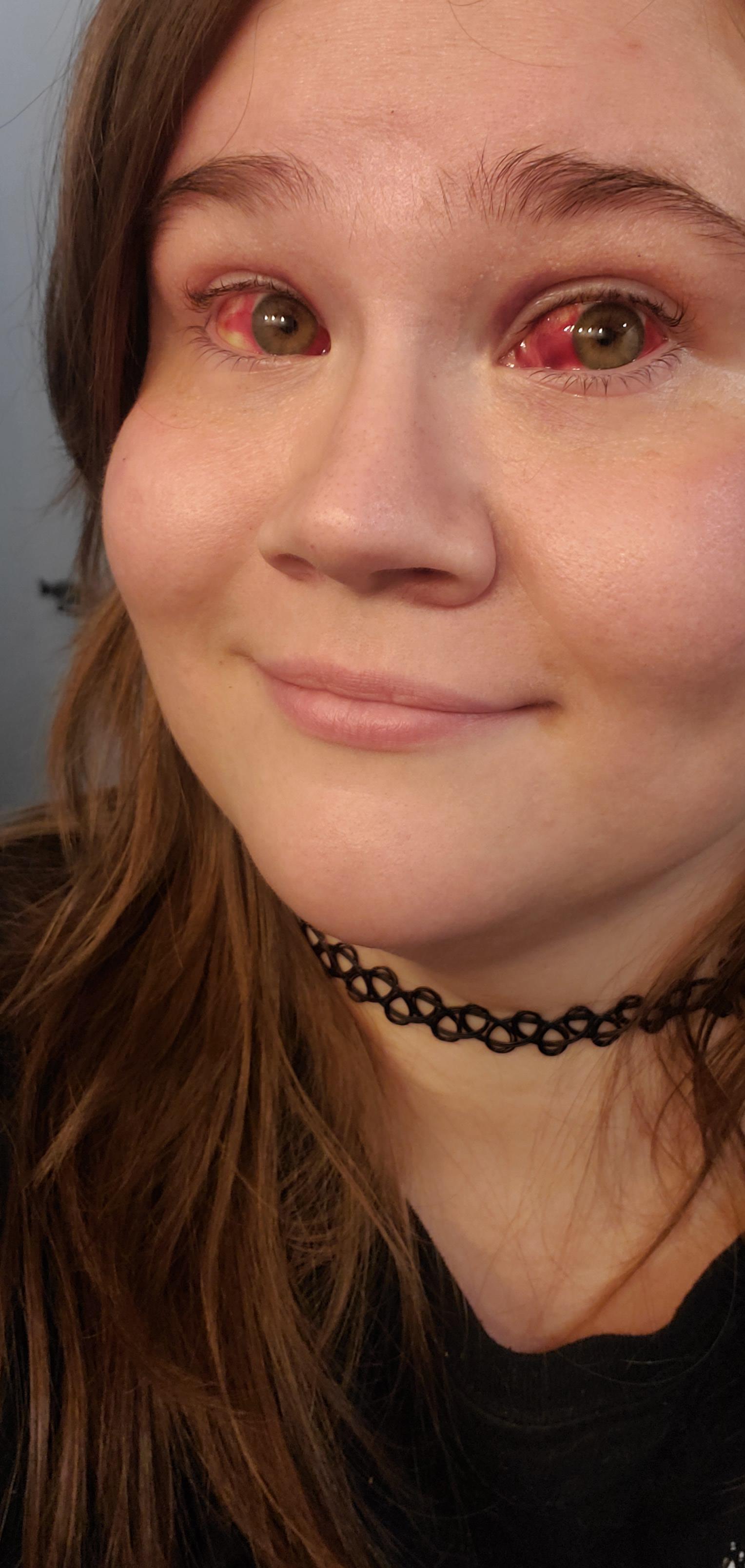 Result of seriously violent puking when my gallbladder decided to beat