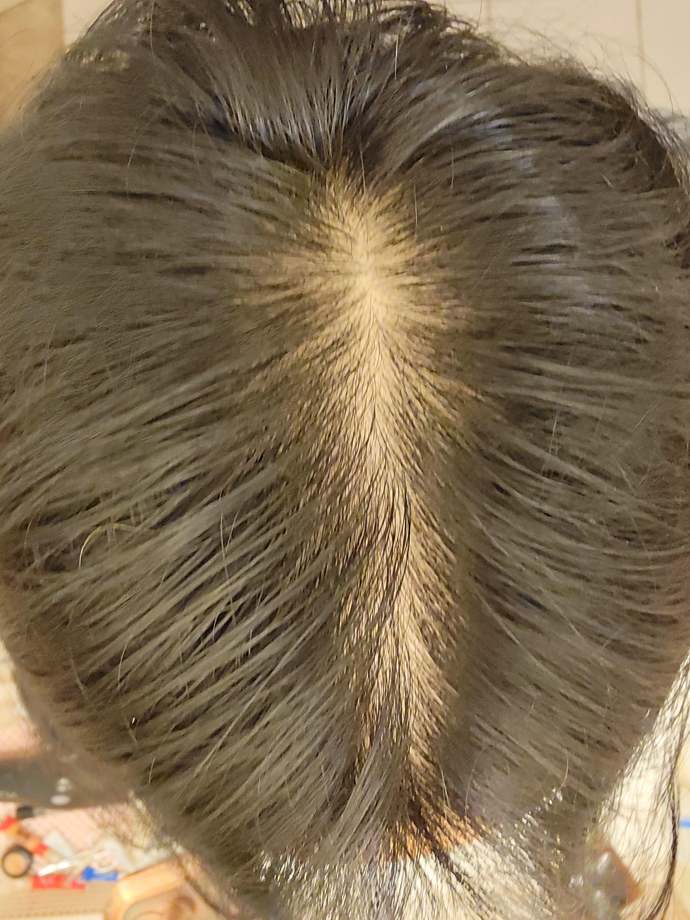 Had a wide part for a while and don't know if it's hair thinning or normal? r/malehairadvice