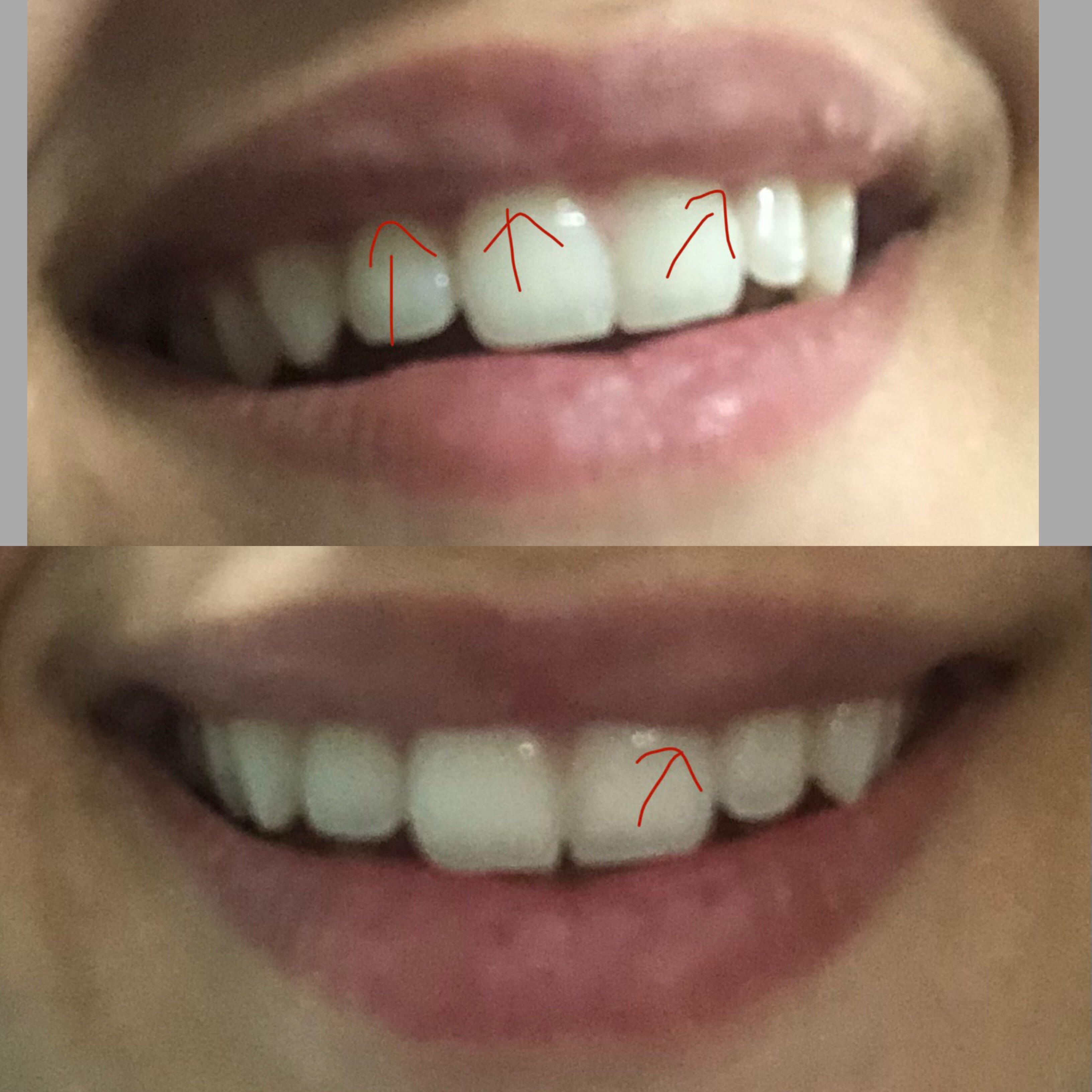 Lumpy lips after 0.6 Juvederm (NLL). 2 weeks in, should I wait or dissolve? r/PlasticSurgery