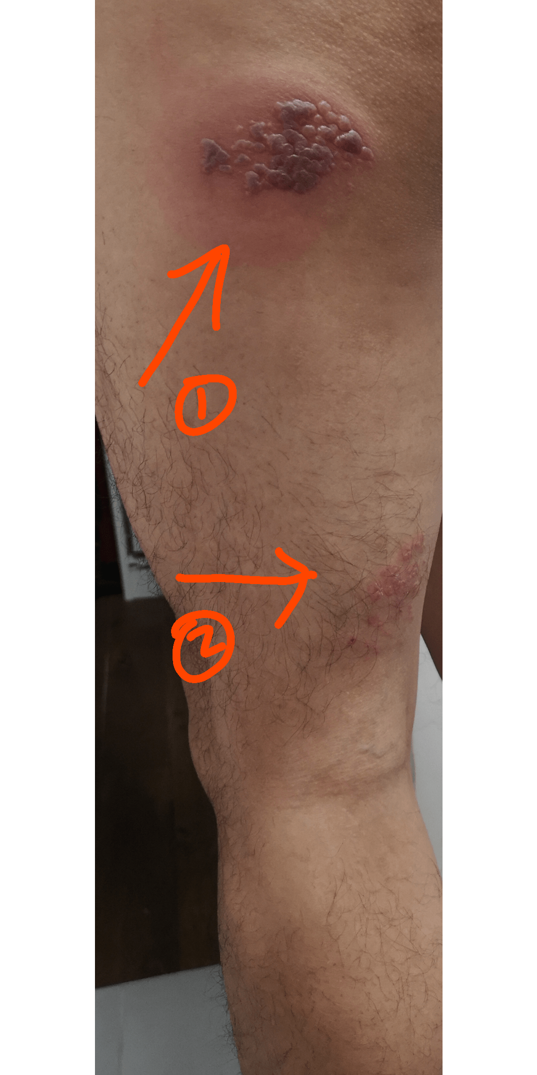 Rash on upper thigh, lower thigh and foot r/shingles