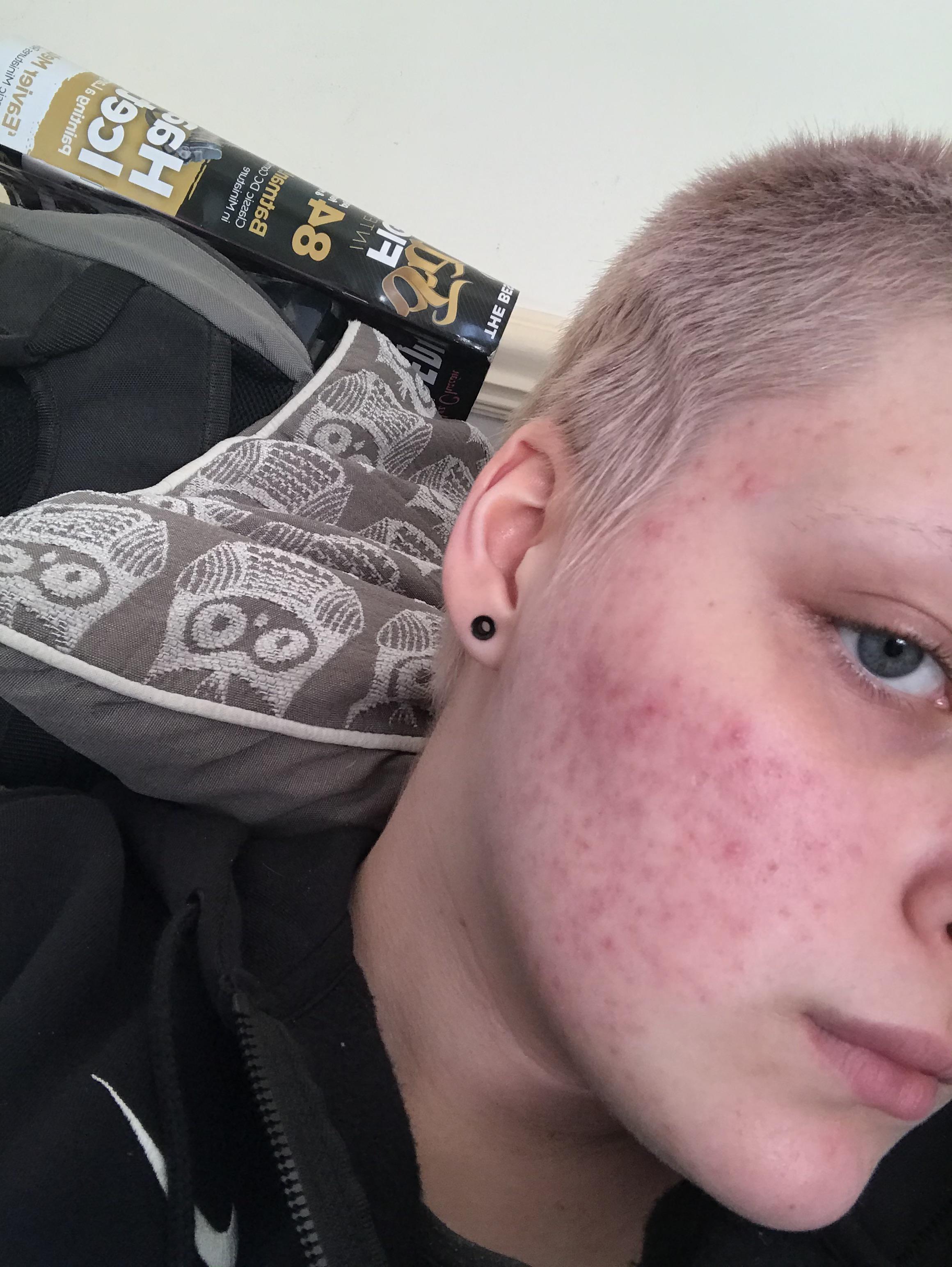 Best treatment for acne scarring like this? r/acne