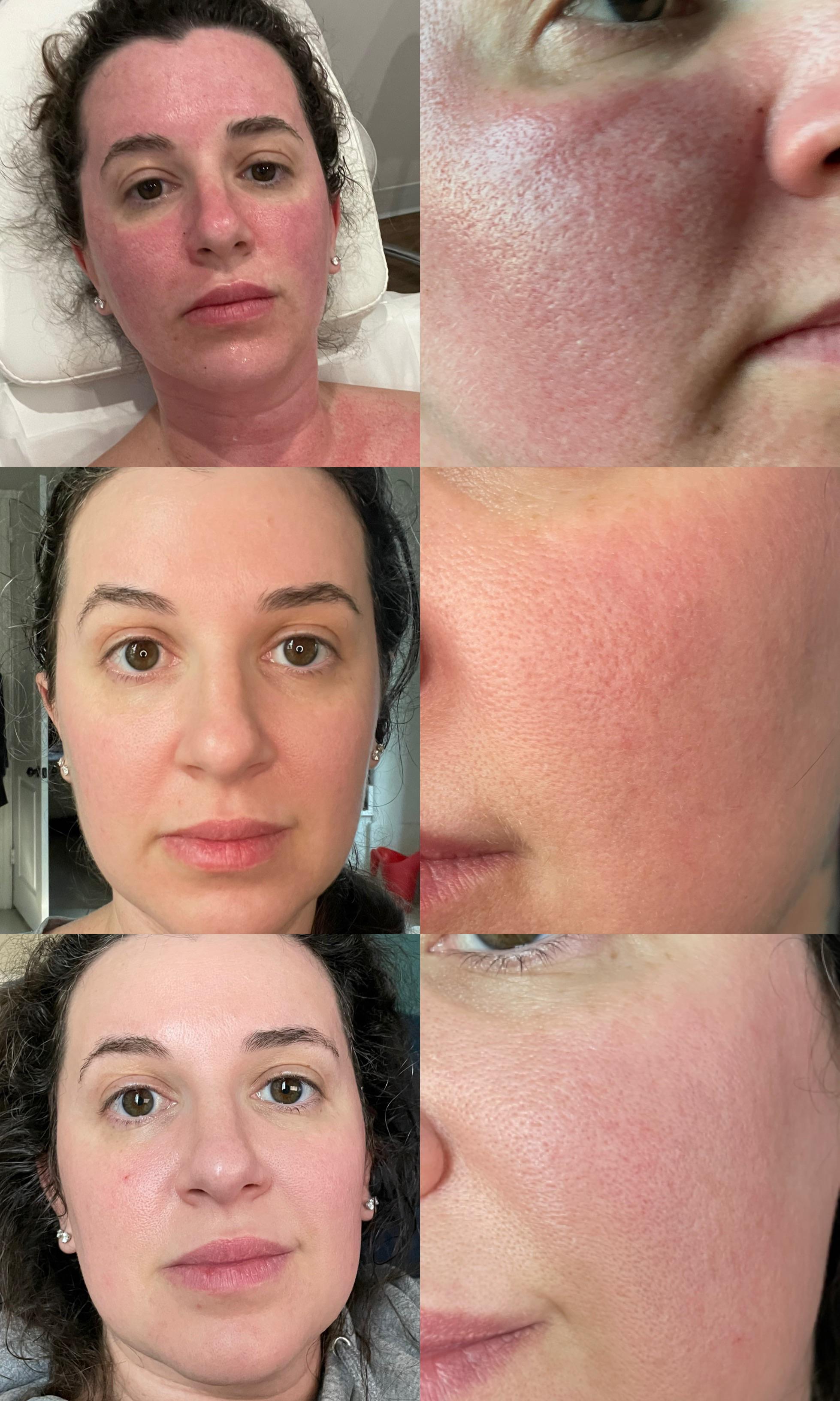 Update on Halo/BBL laser treatment on face, neck & chest r/30PlusSkinCare