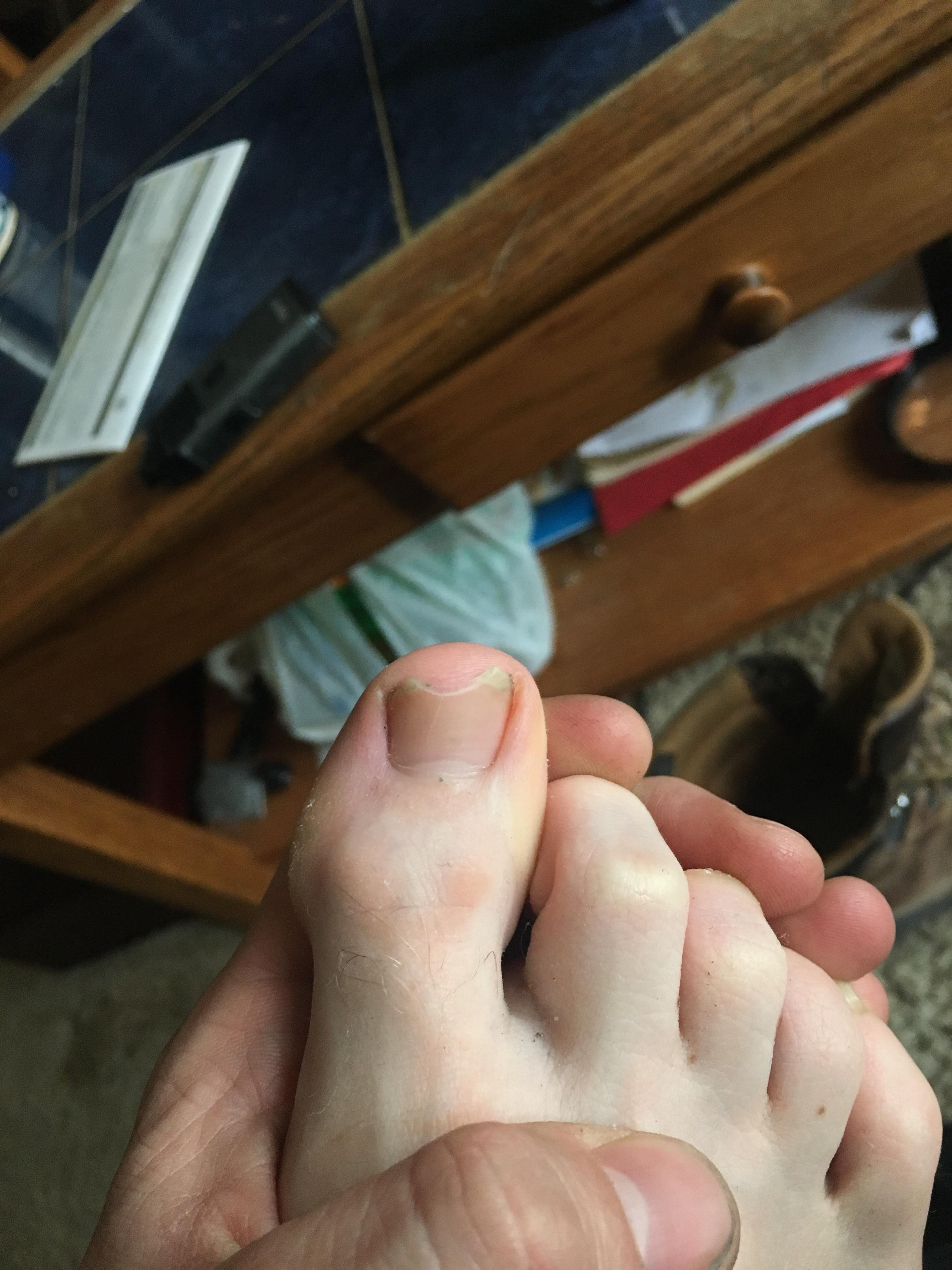 My toe rubs against the steel toe of my work boots and keeps my nail