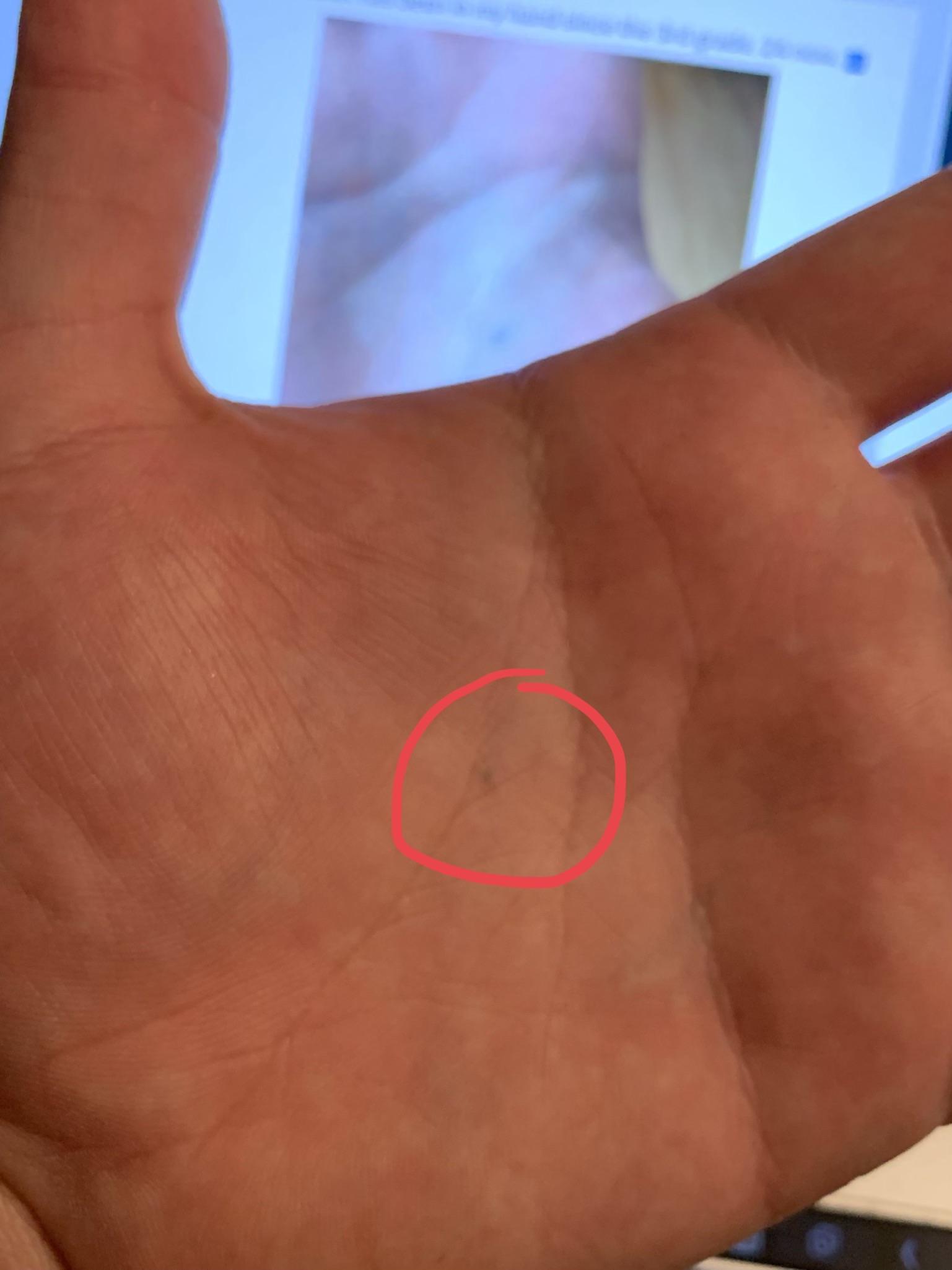 Someone posted a picture of pencil lead that’s been stuck in their hand since 3rd grade; I