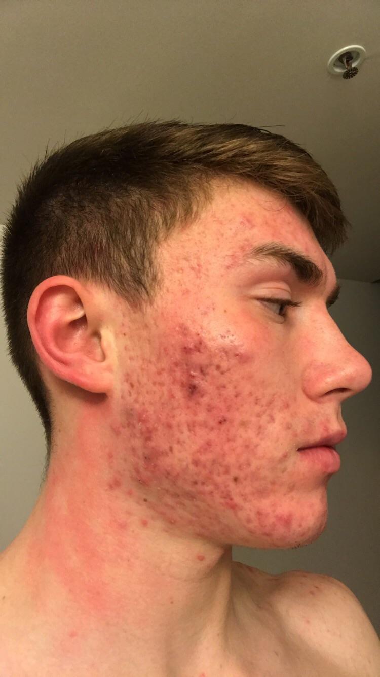 severe cystic acne, i need help r/acne