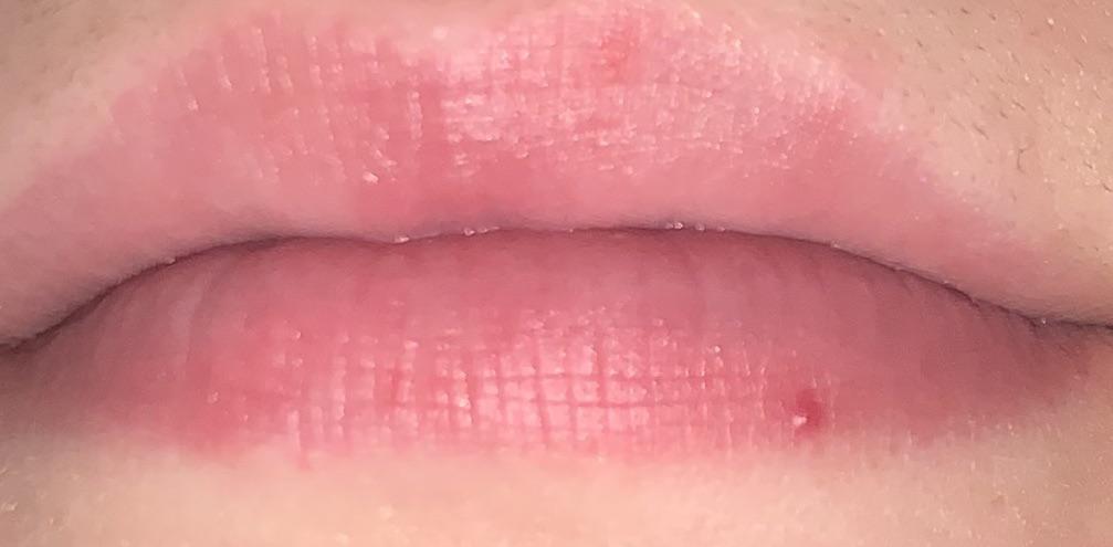 Little red spot appeared on my lip months ago, any idea what it is