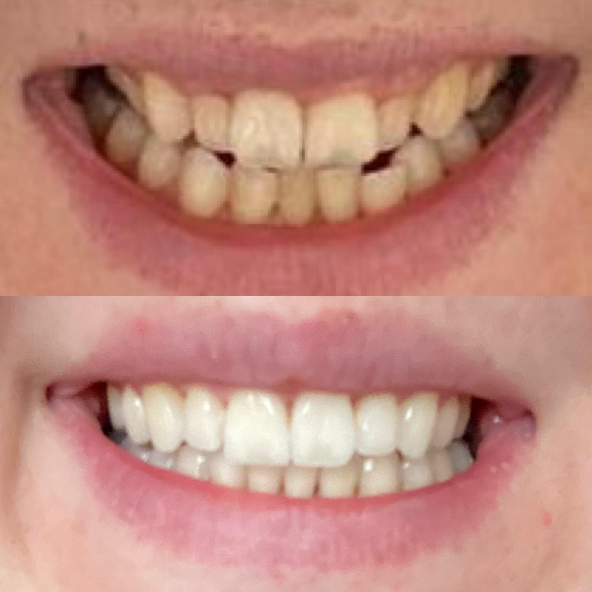 Had my attachments taken off today! 25 trays and no refinements! Just 3