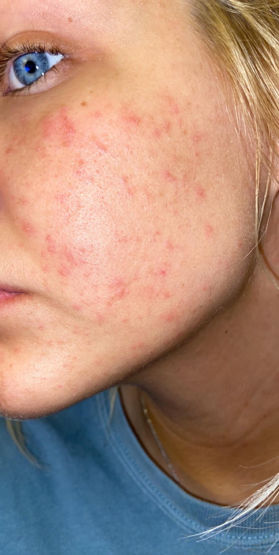 Help!! I think i’m having an allergic reaction to my milk makeup highlighter or my laundry